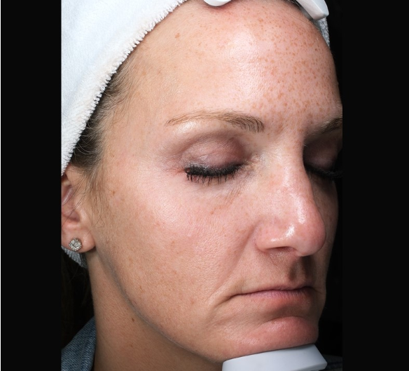 Patient 27 Before Image