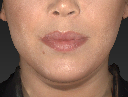 Patient 46 Before Image