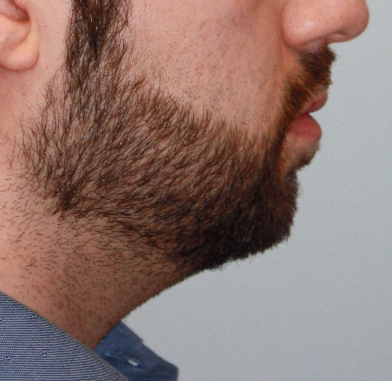 Patient 37 Before Image