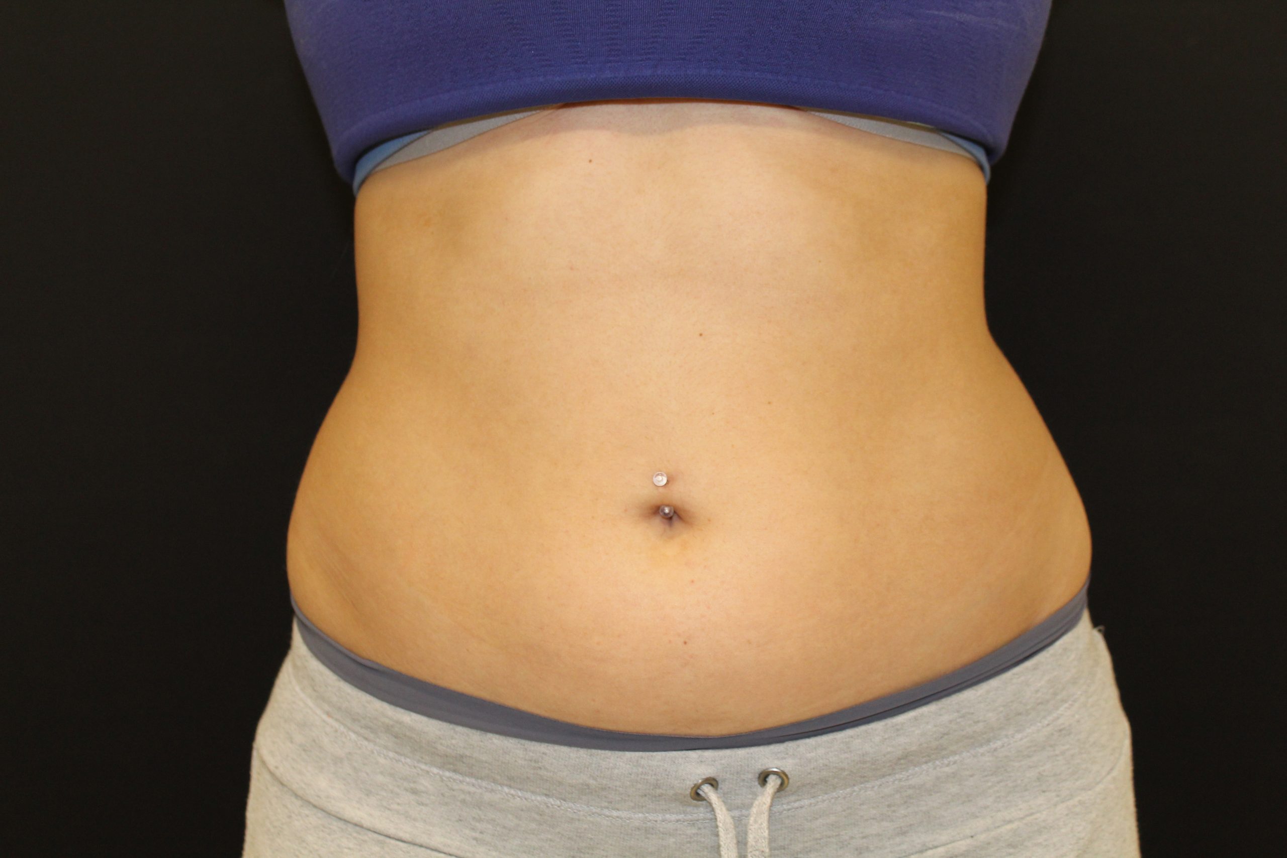 Patient 53 Before Image