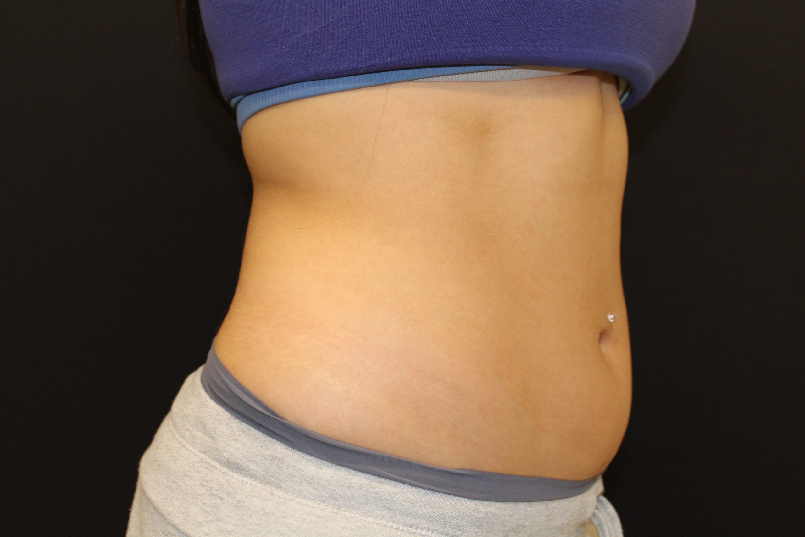 Patient 53 Before Image