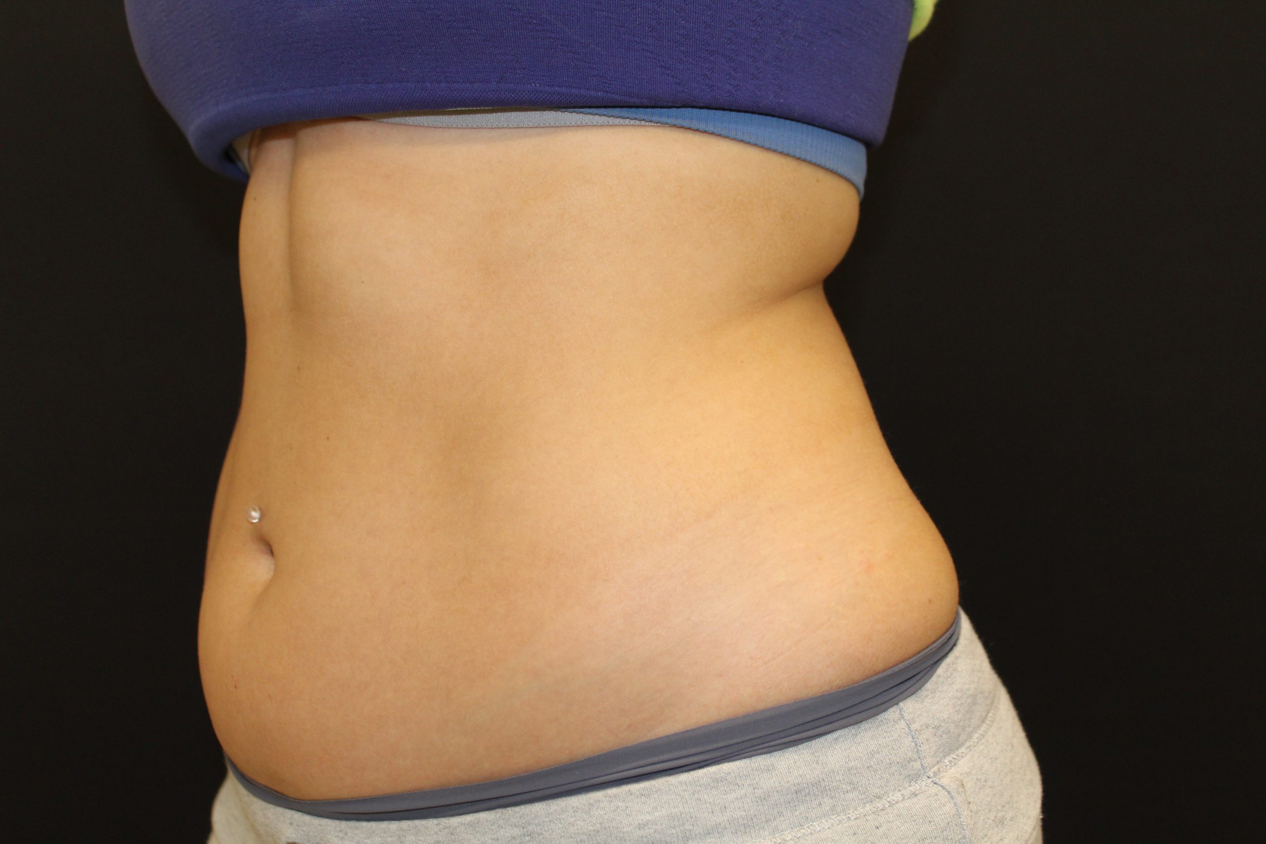 Patient 53 Before Image