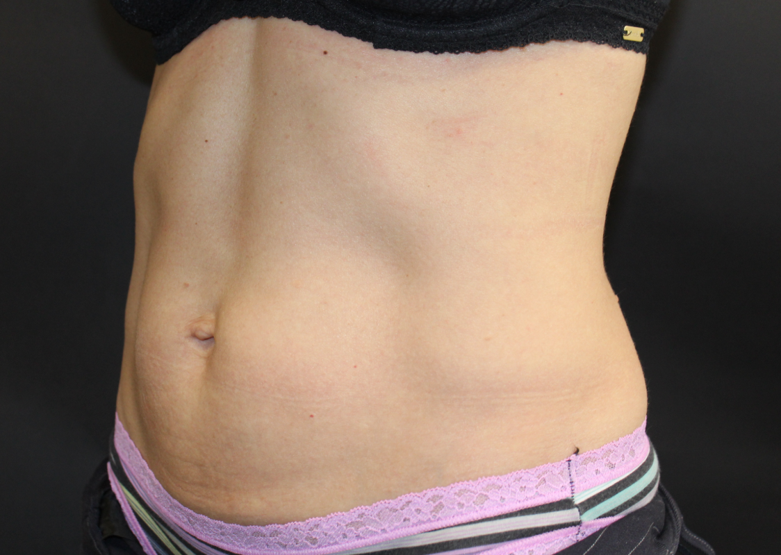 Patient 42 Before Image