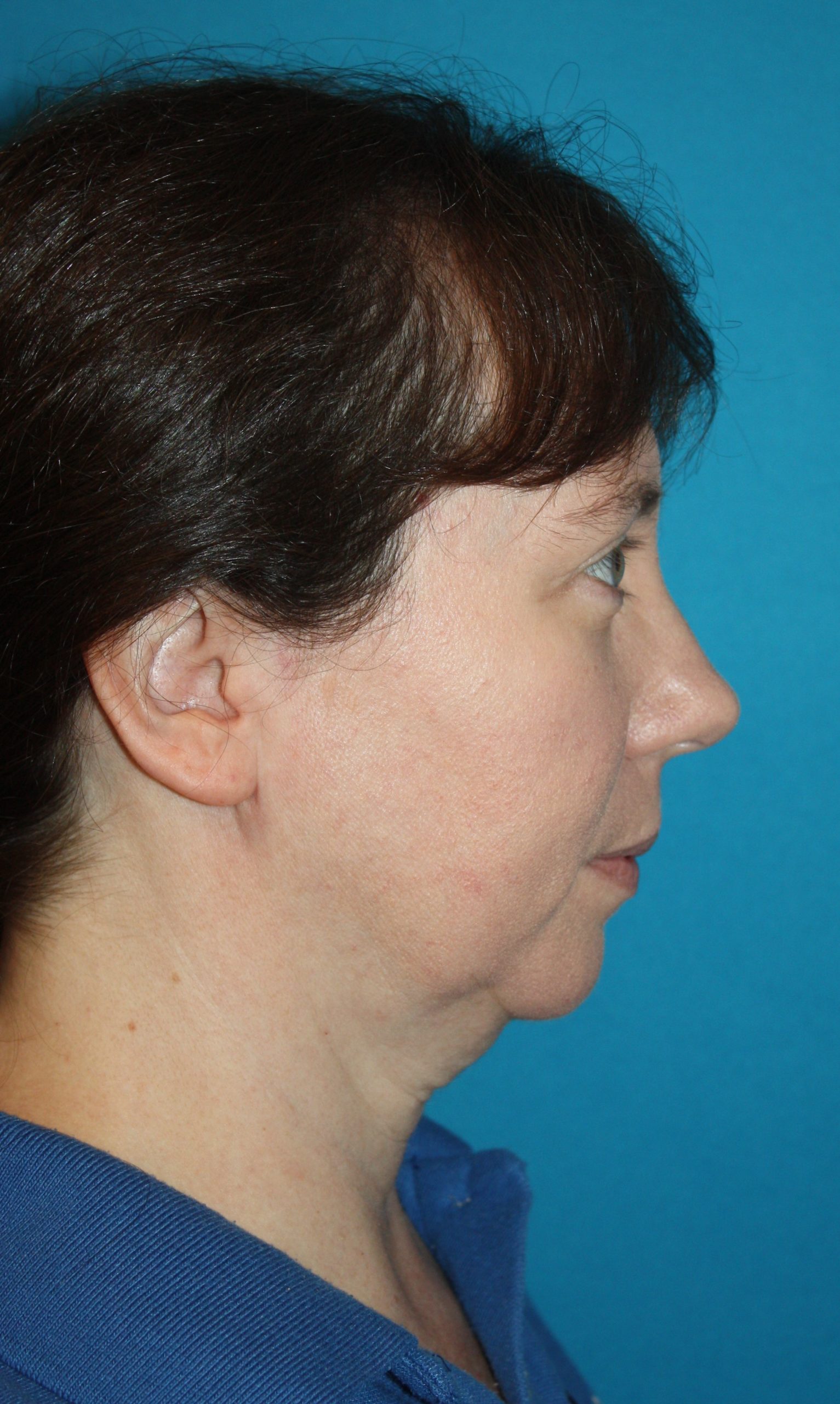 Patient 55 Before Image
