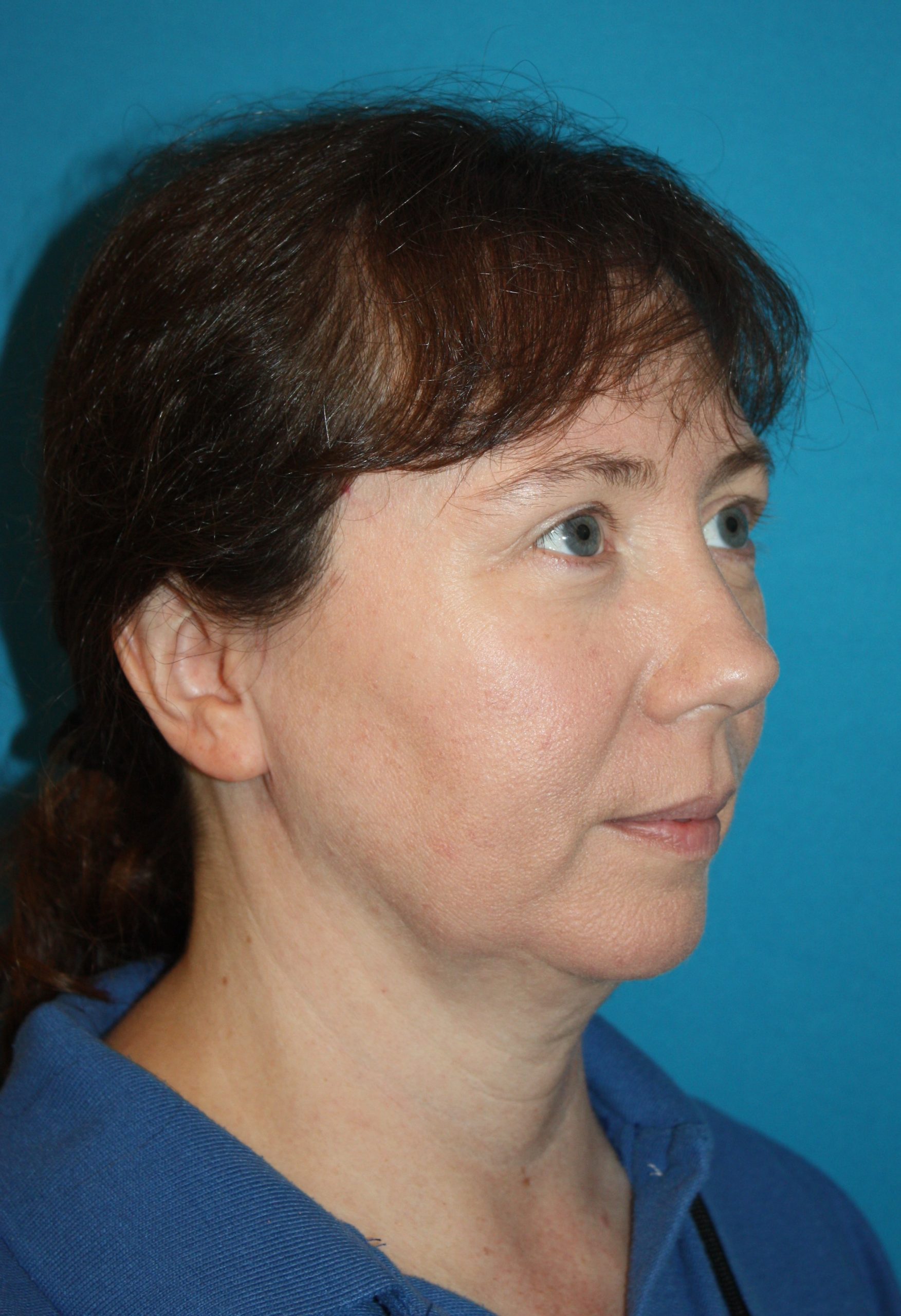 Patient 55 Before Image