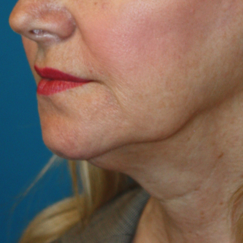 Patient 56 Before Image