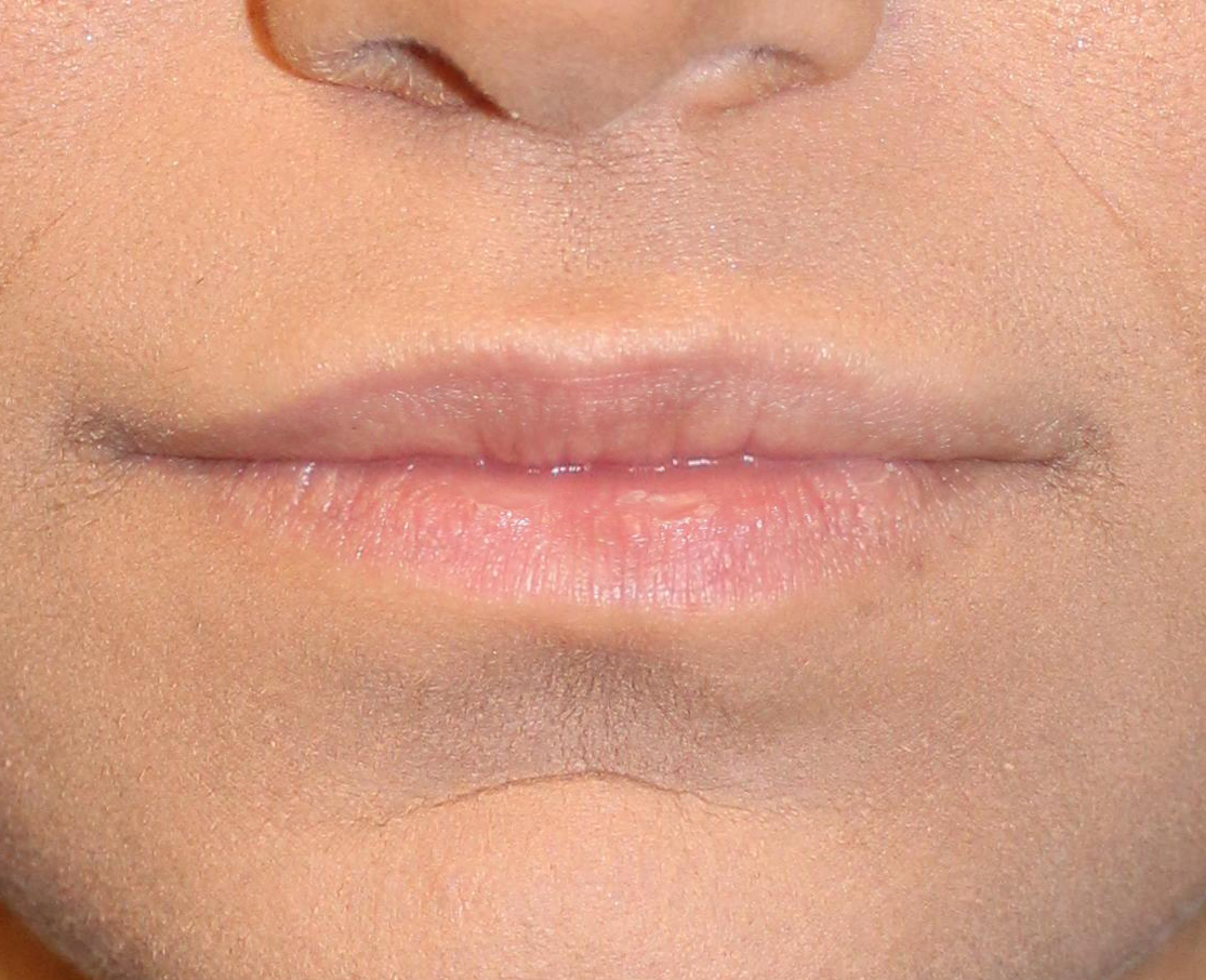 Patient 36 Before Image