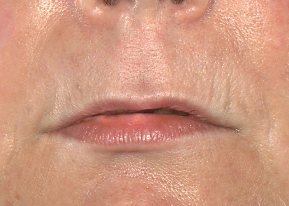 Patient 41 Before Image