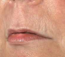 Patient 41 Before Image