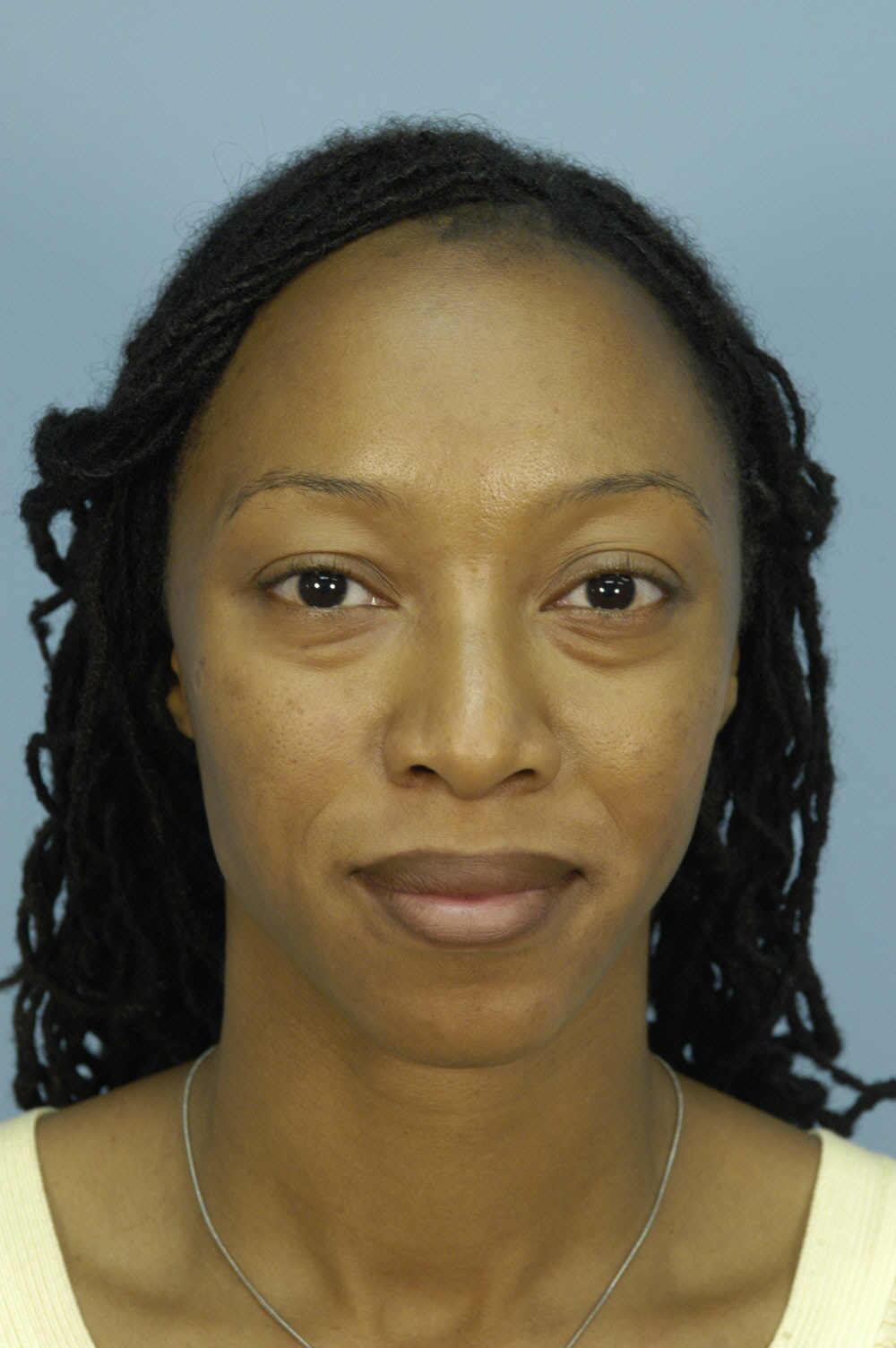 Patient 43 Before Image