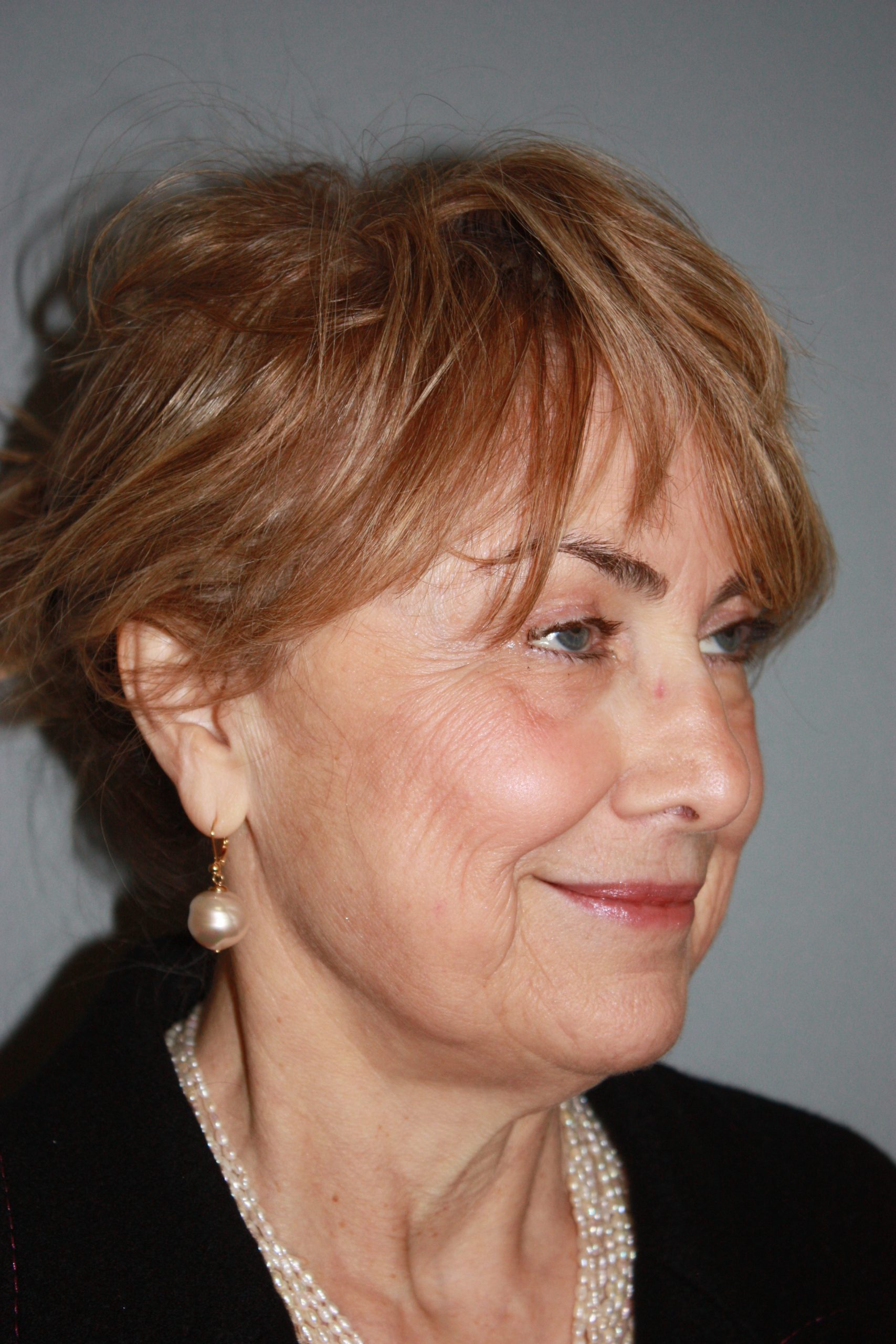 Patient 50 Before Image