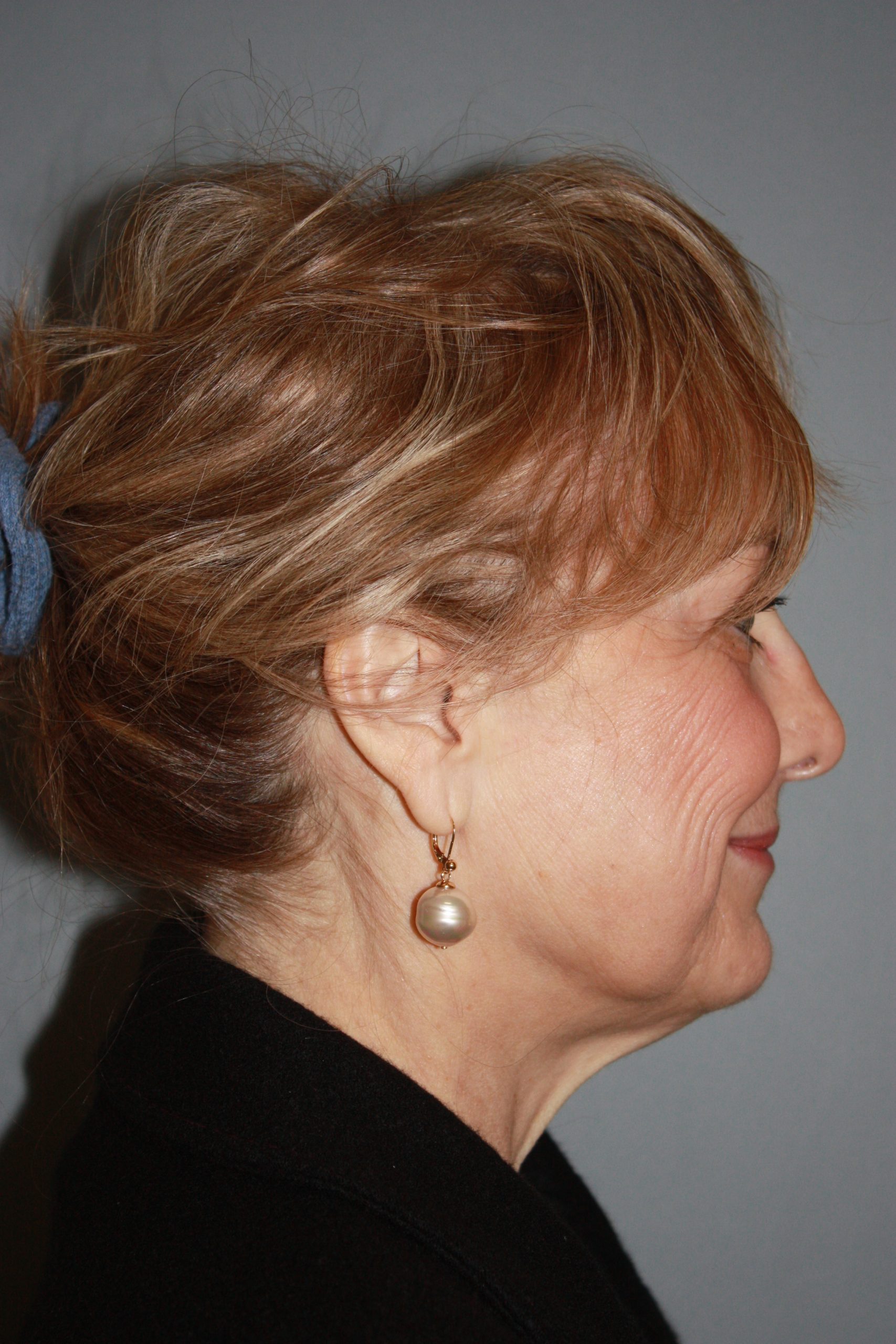 Patient 50 Before Image