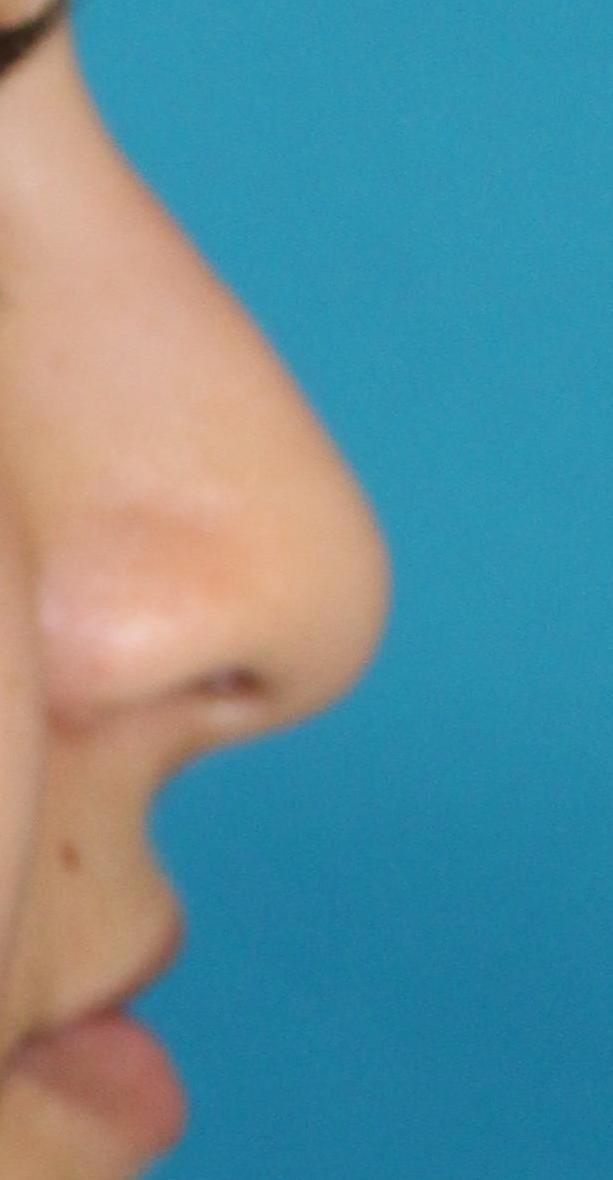 Patient 38 Before Image