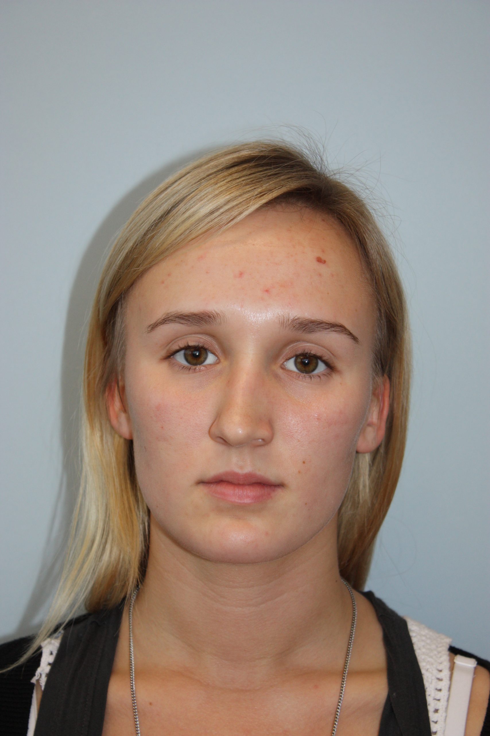 Patient 51 Before Image