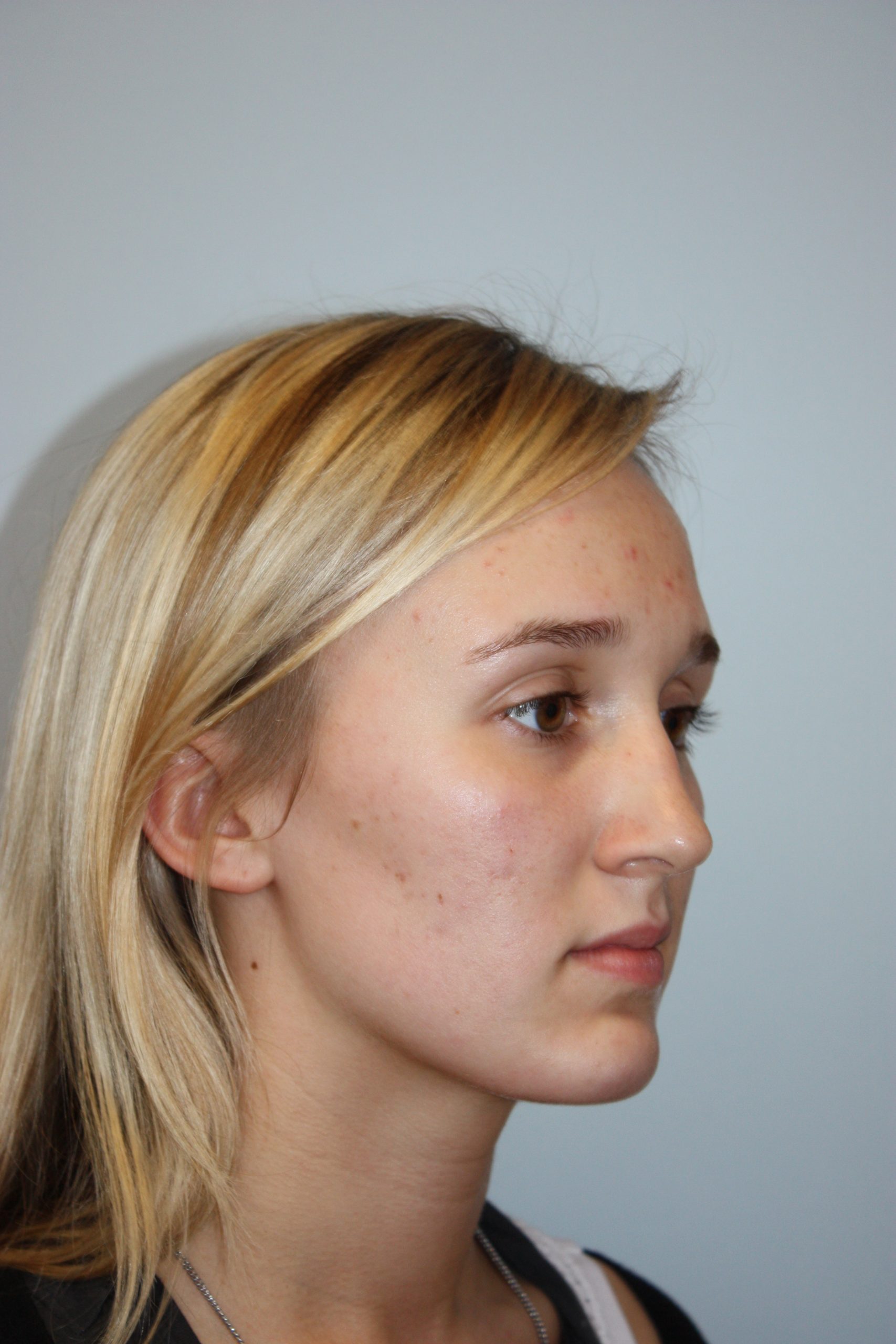 Patient 51 Before Image