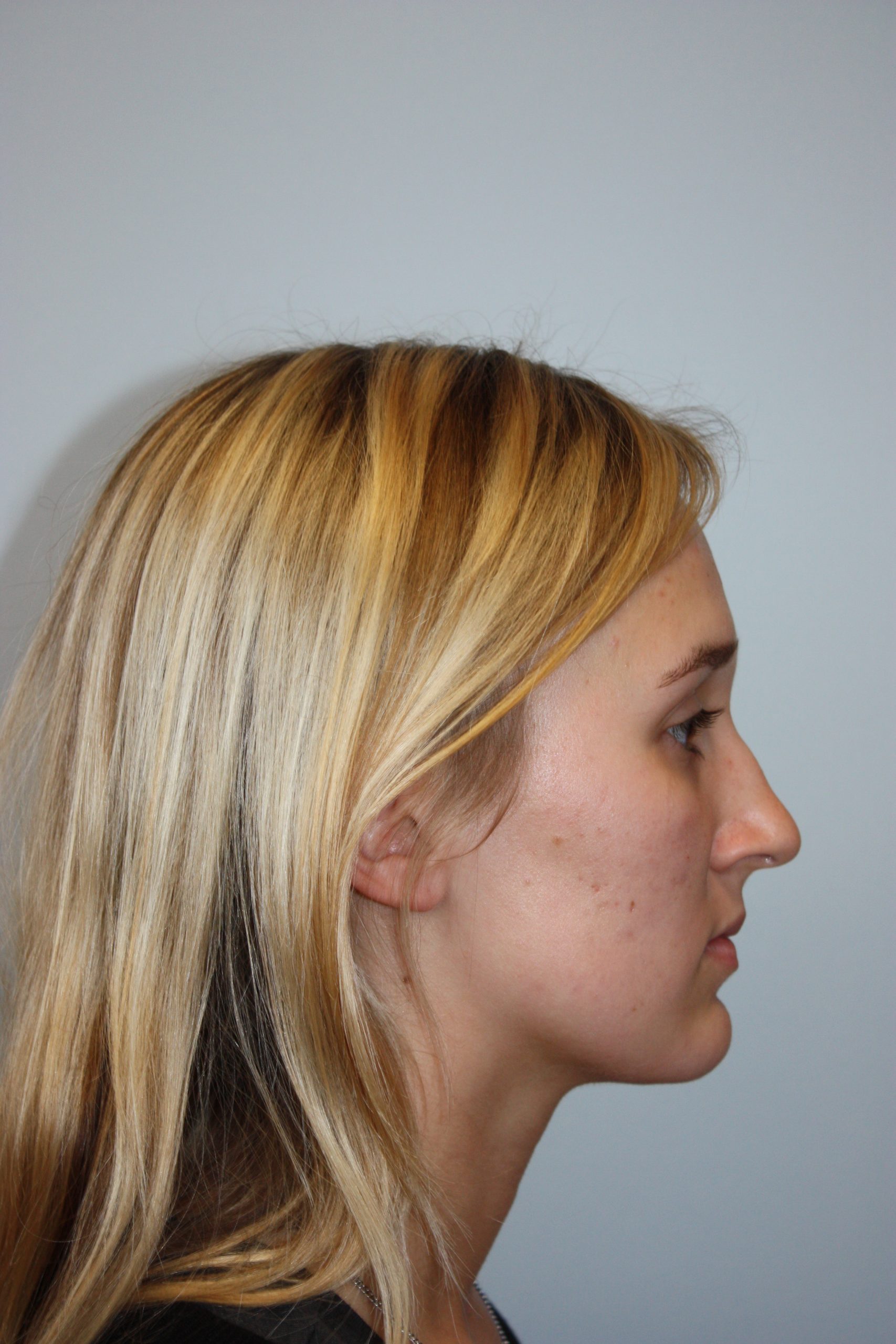 Patient 51 Before Image