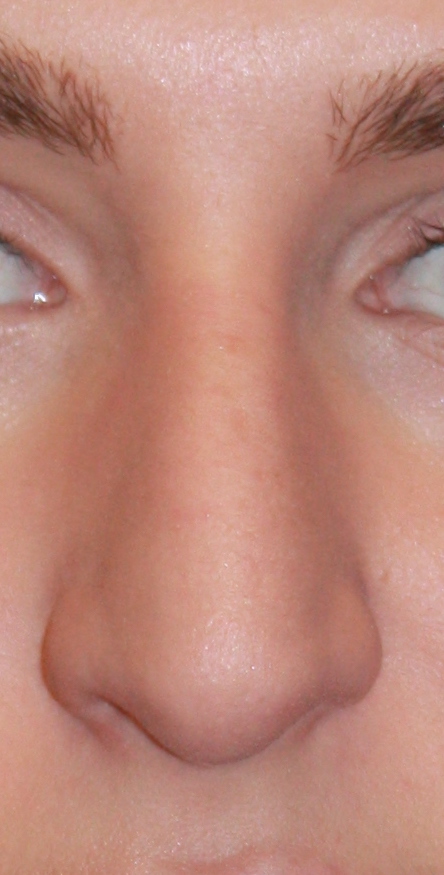 Patient 39 Before Image