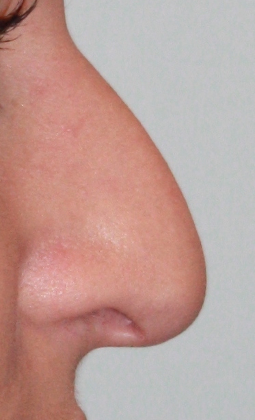 Patient 39 Before Image