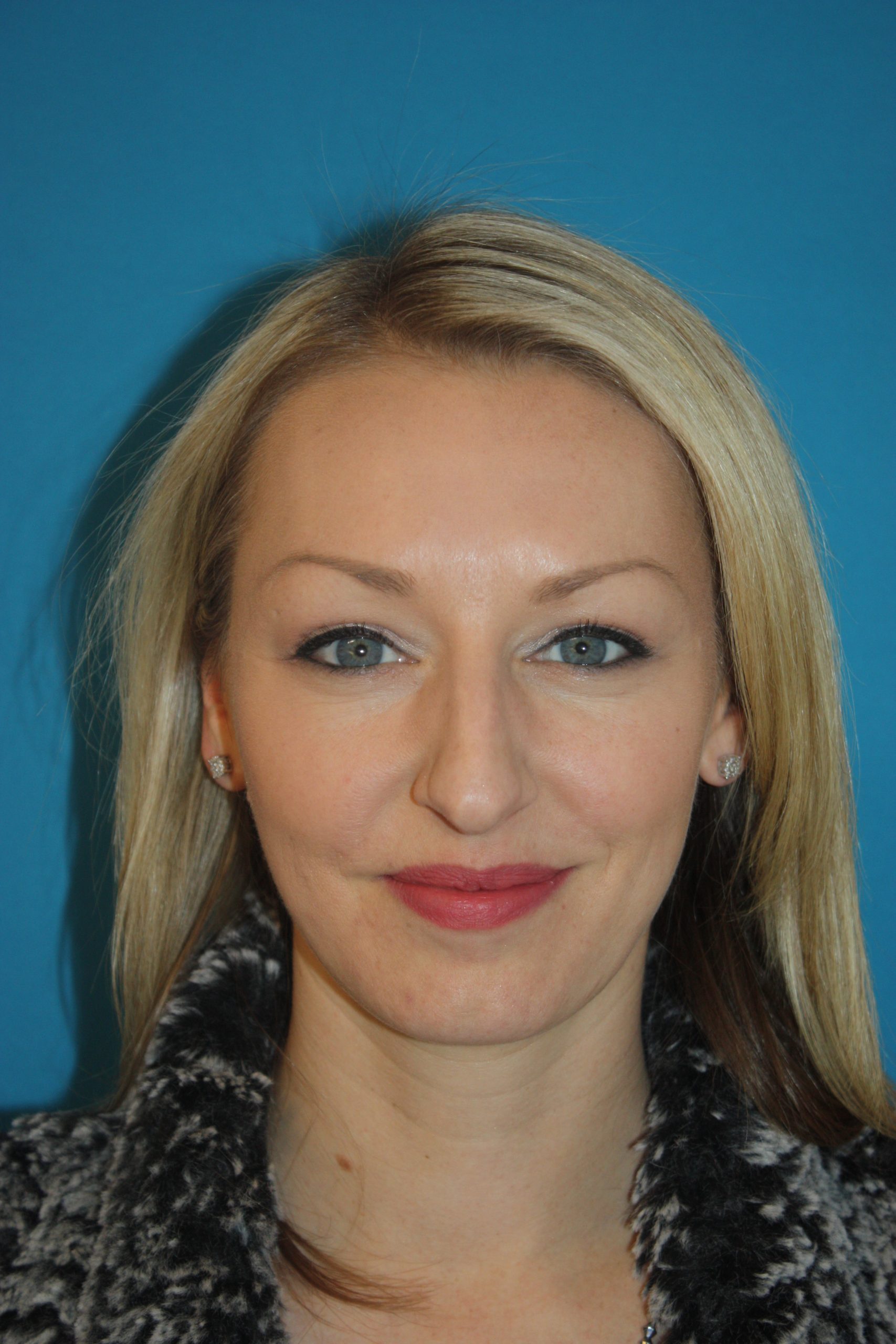 Patient 44 Before Image