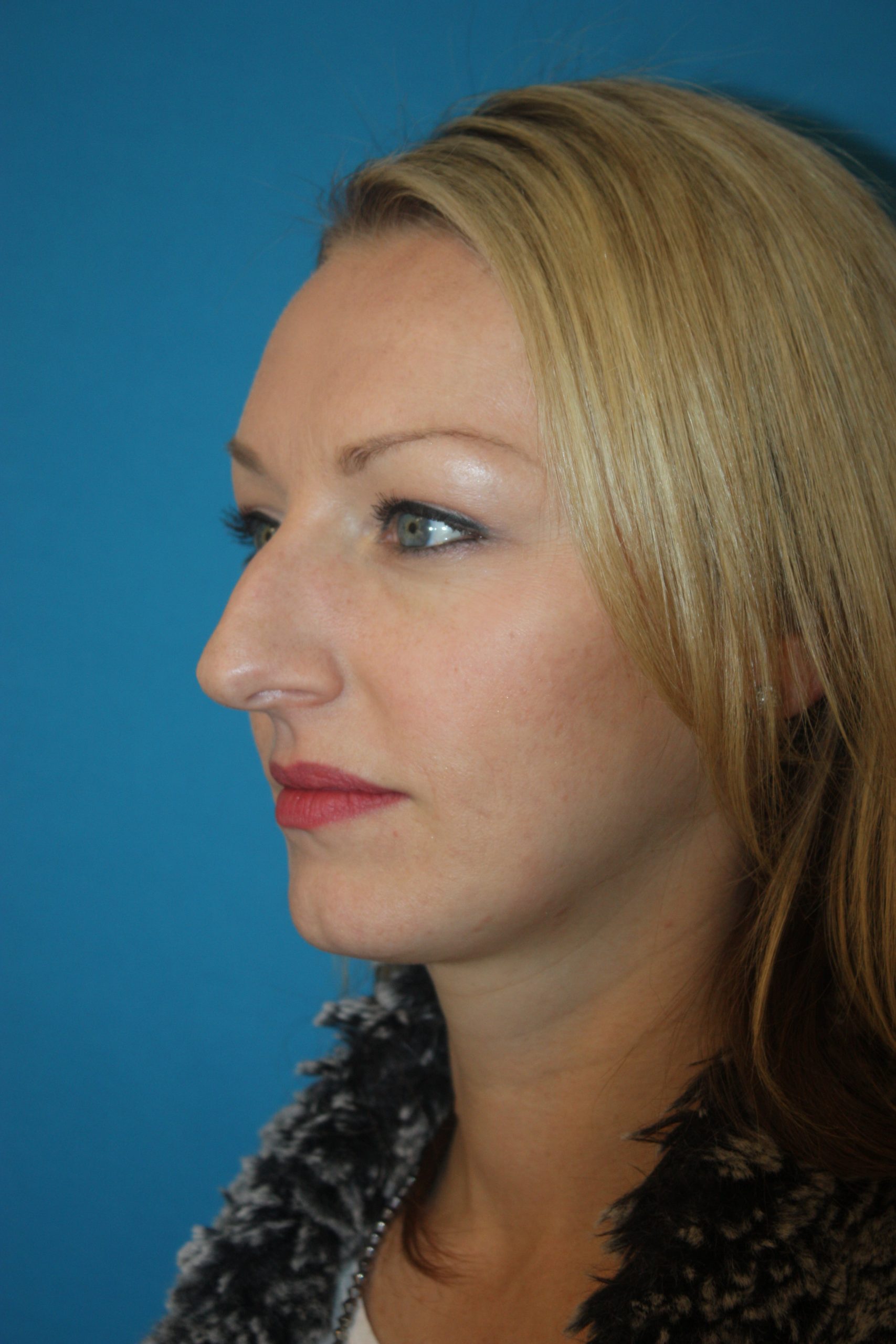 Patient 44 Before Image