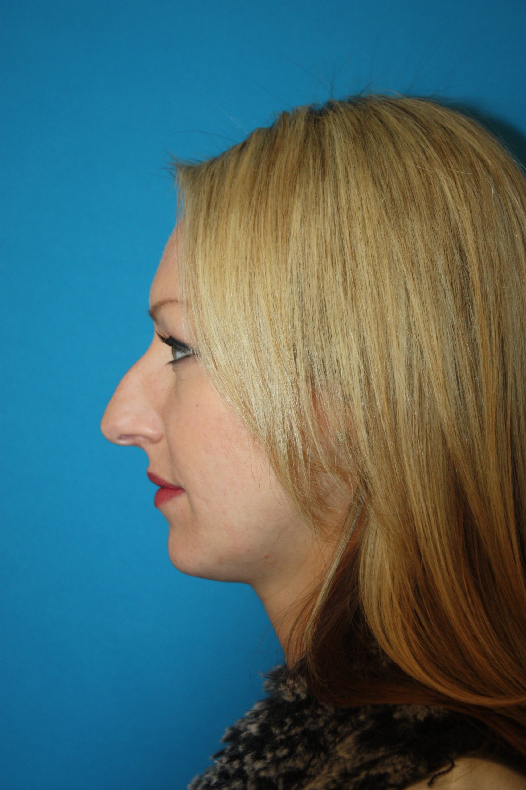 Patient 44 Before Image