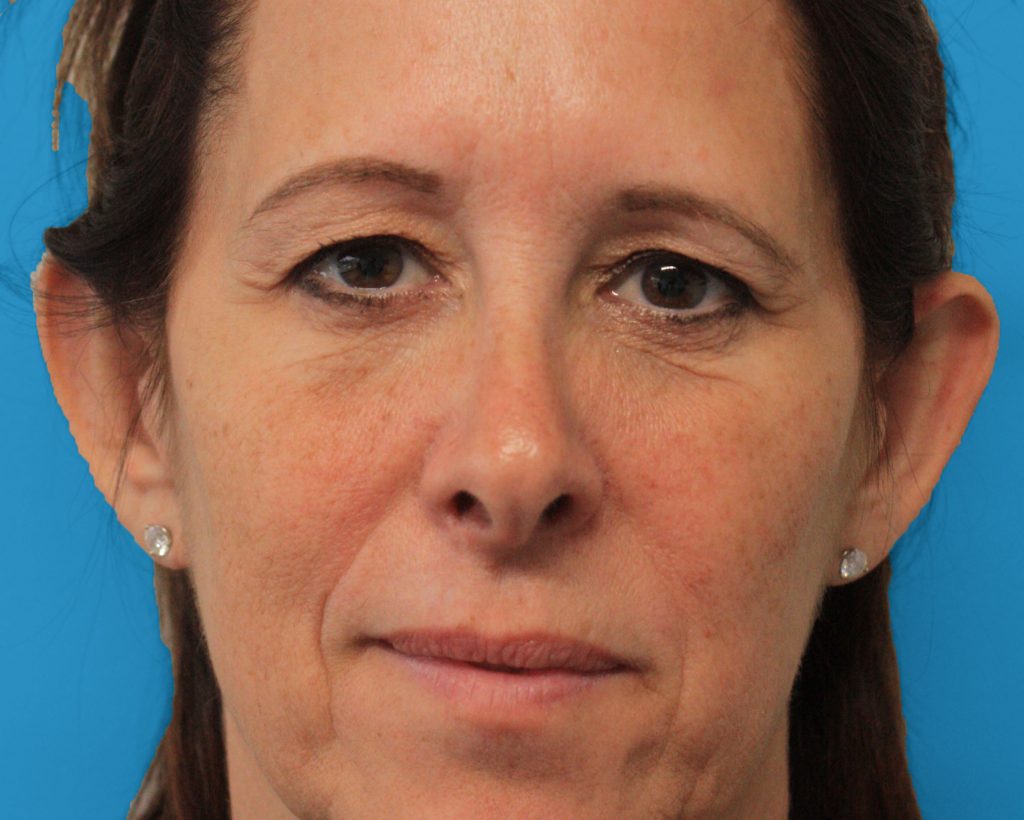 Patient 32 Before Image