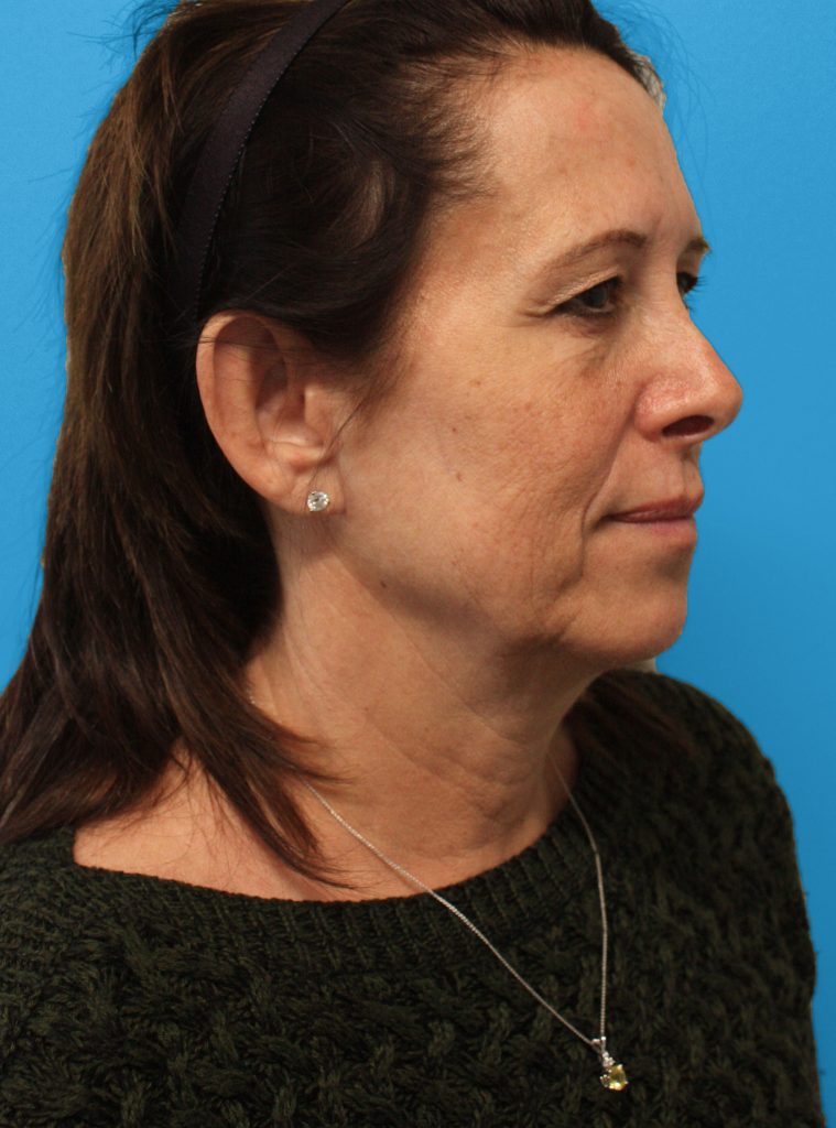 Patient 32 Before Image