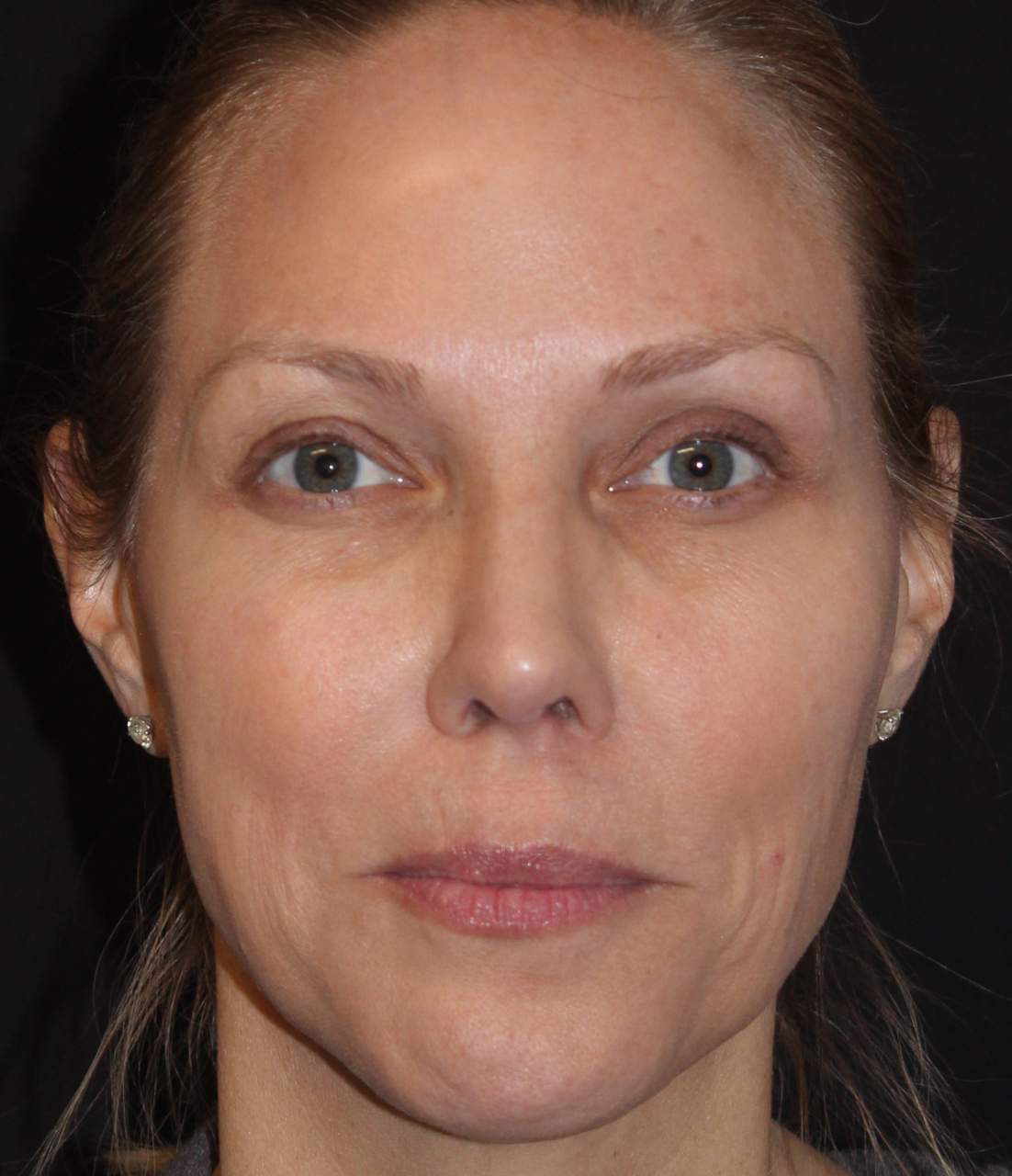 Patient 103 After Image