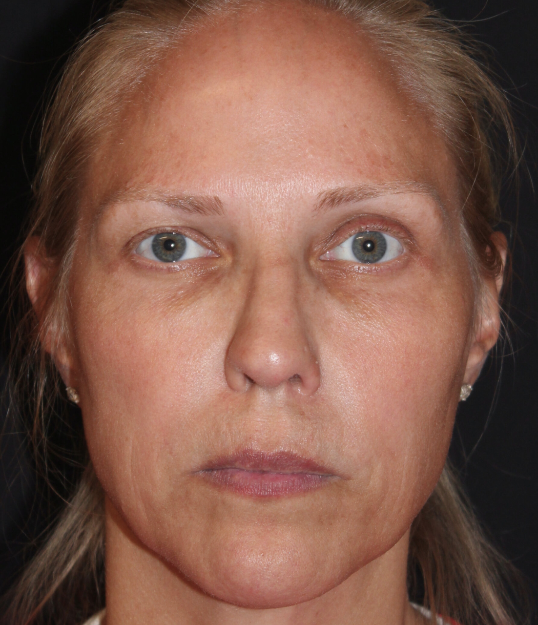 Patient 103 Before Image