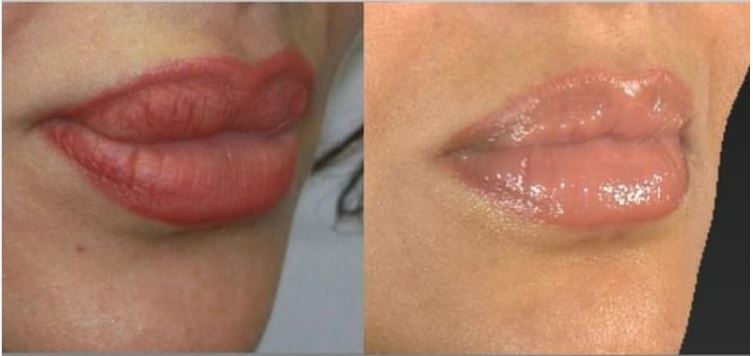 Patient 81 Marge Image