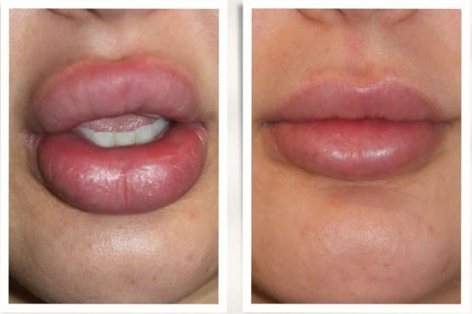 Patient 80 Marge Image