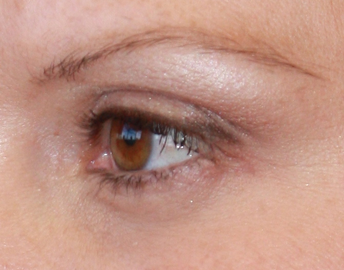 Patient 15 After Image