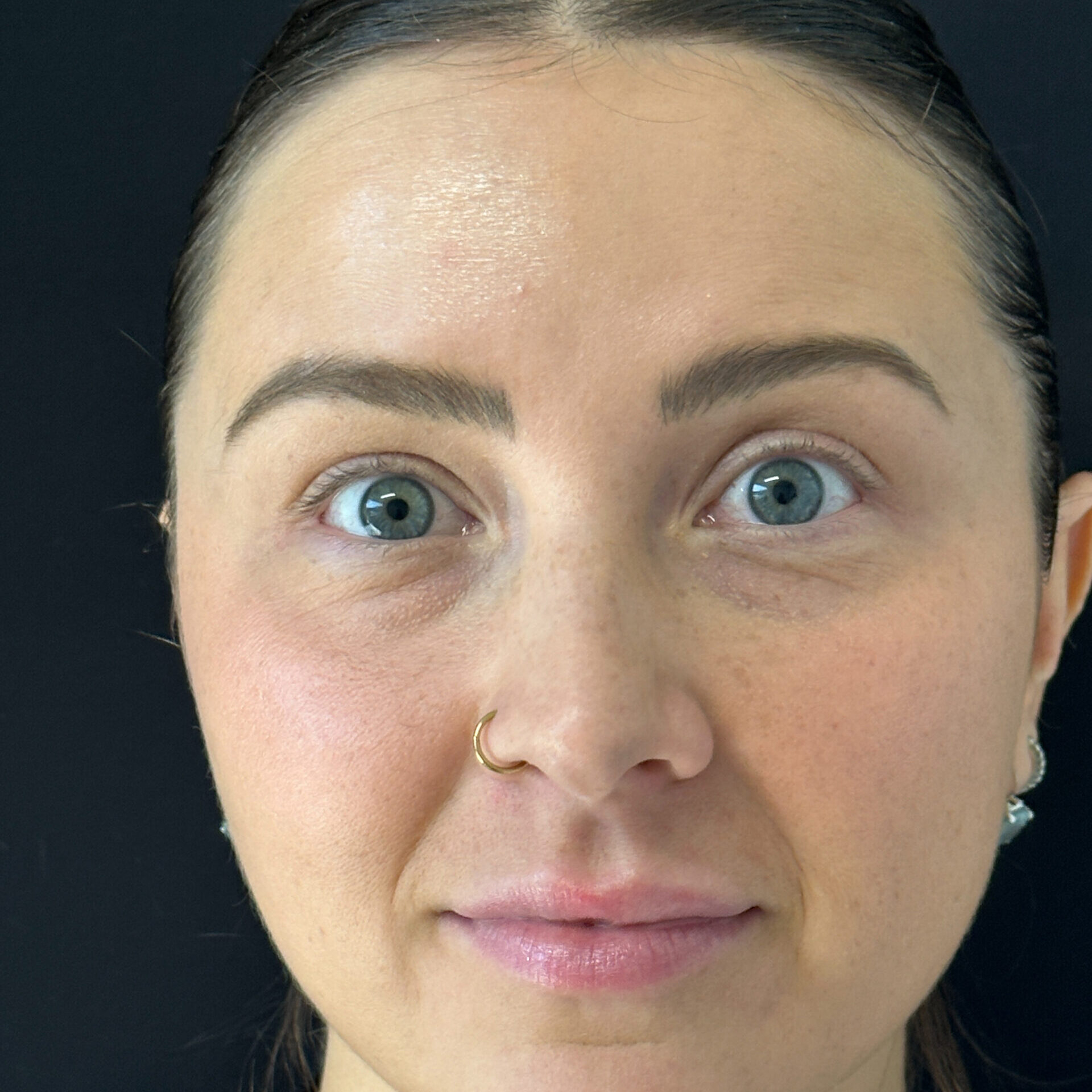 Patient #109 After Image