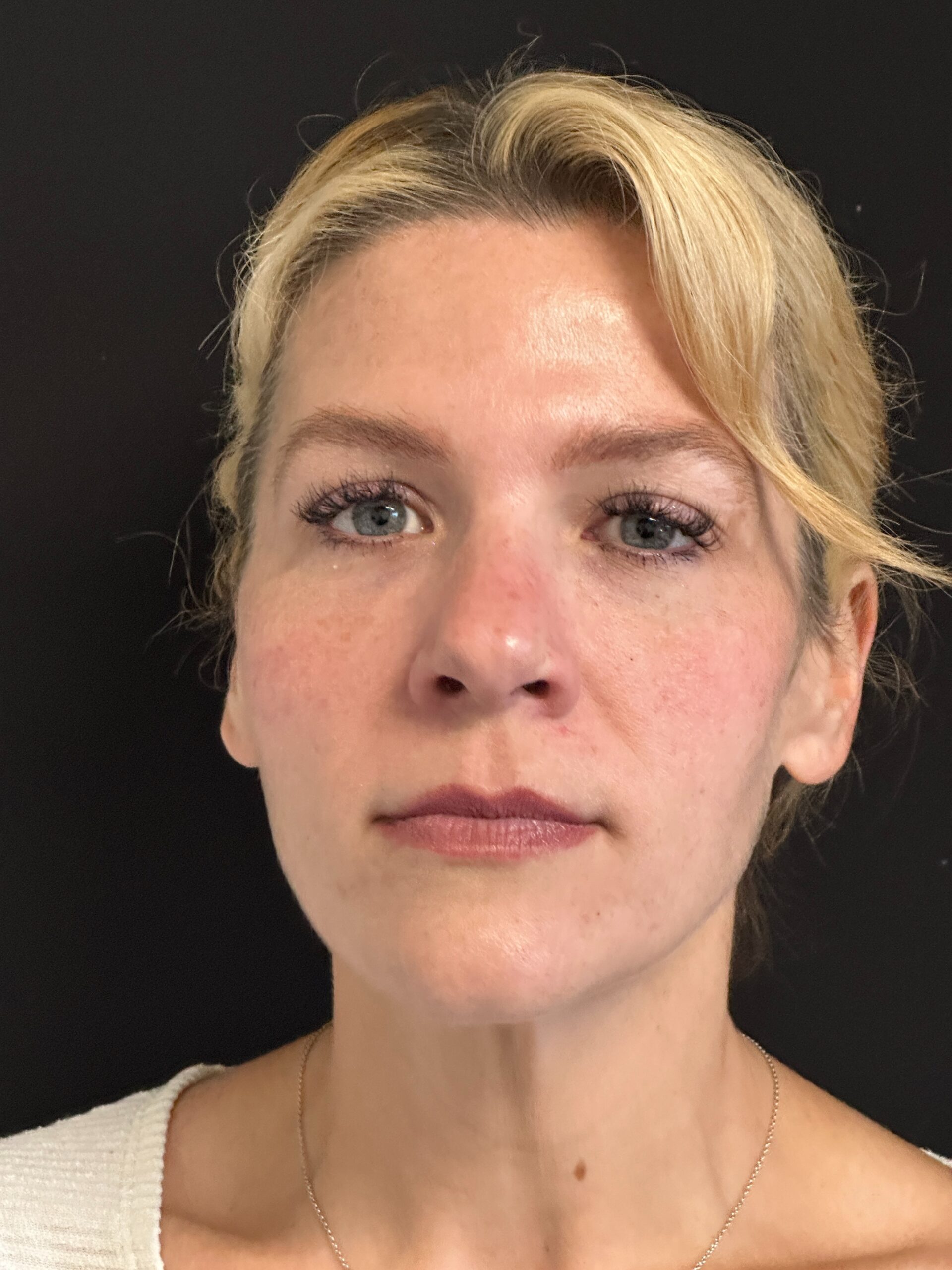 Patient #170 Before Image