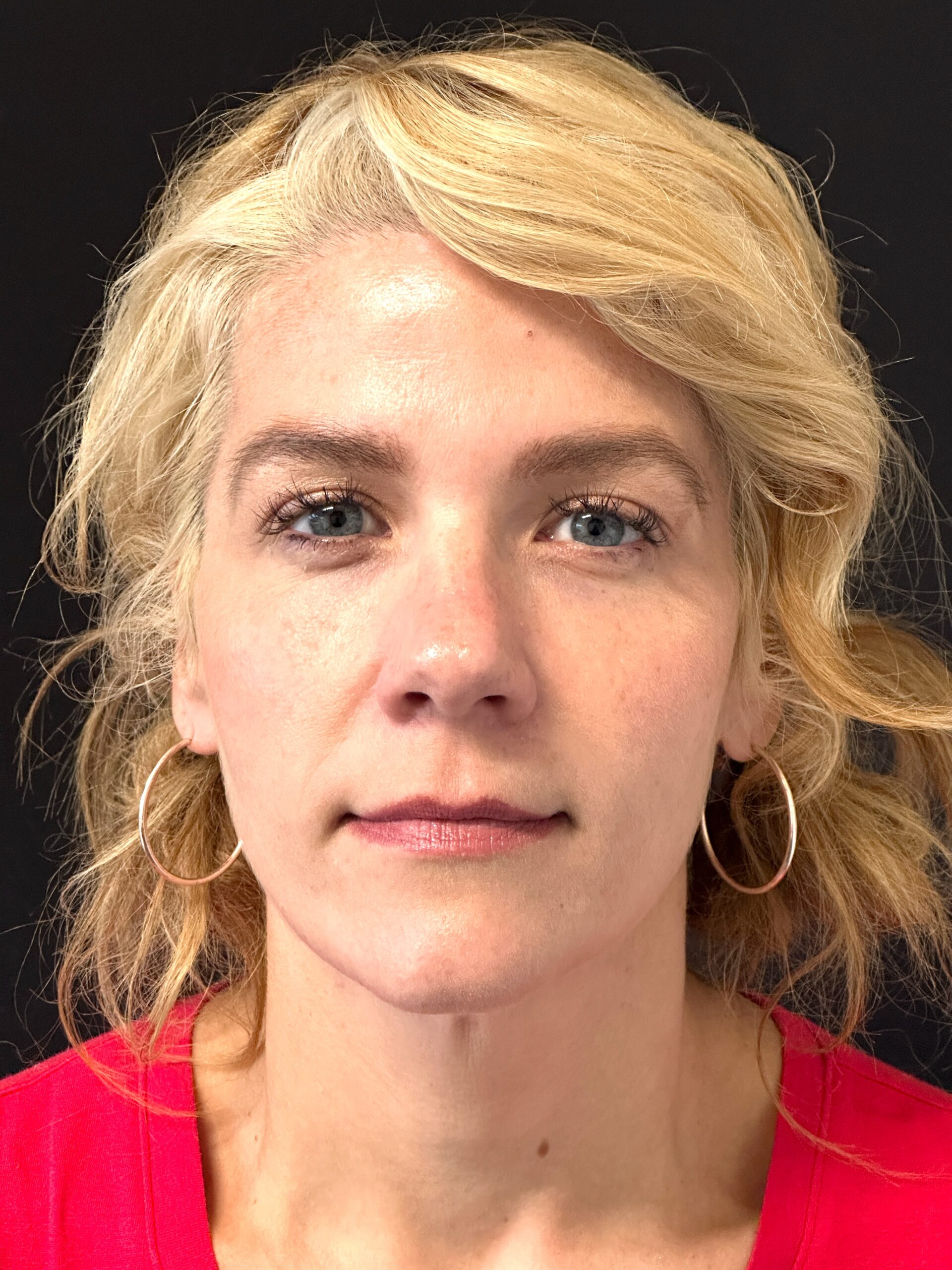 Patient #170 After Image