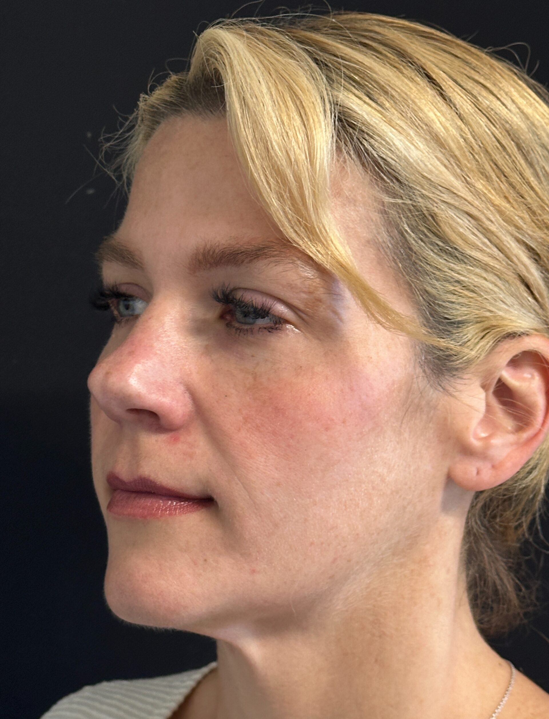 Patient #170 Before Image