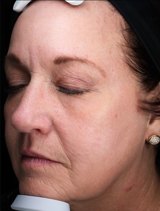 Patient 31 After Image