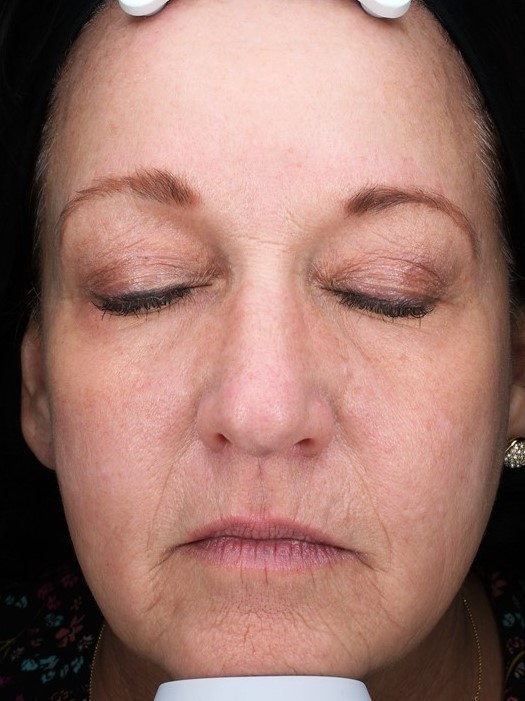 Patient 31 After Image