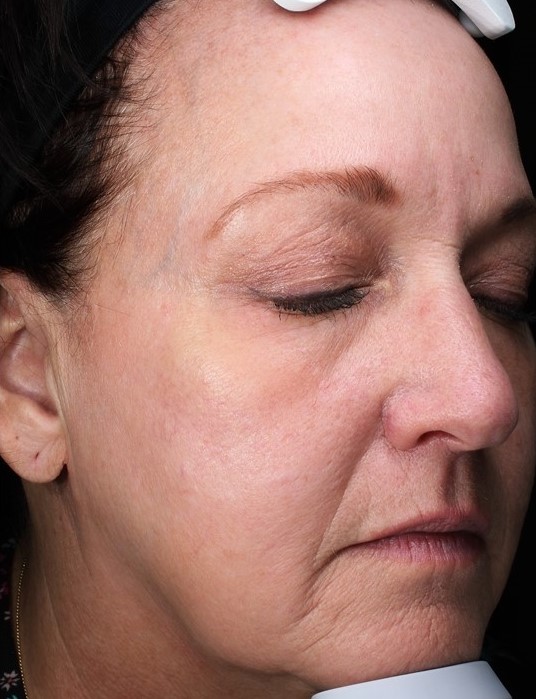 Patient 31 After Image