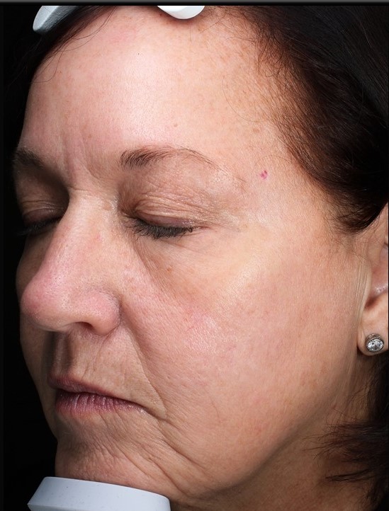 Patient 31 Before Image