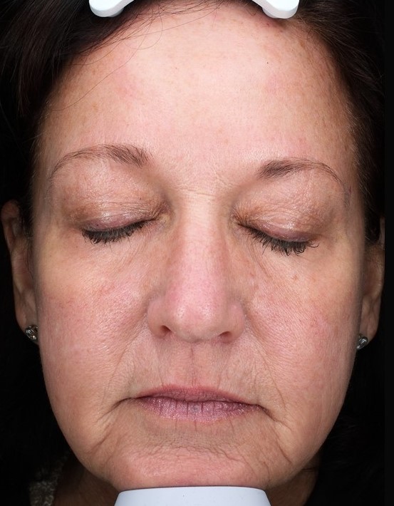 Patient 31 Before Image