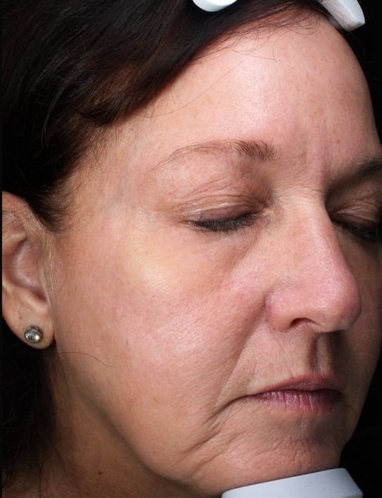 Patient 31 Before Image