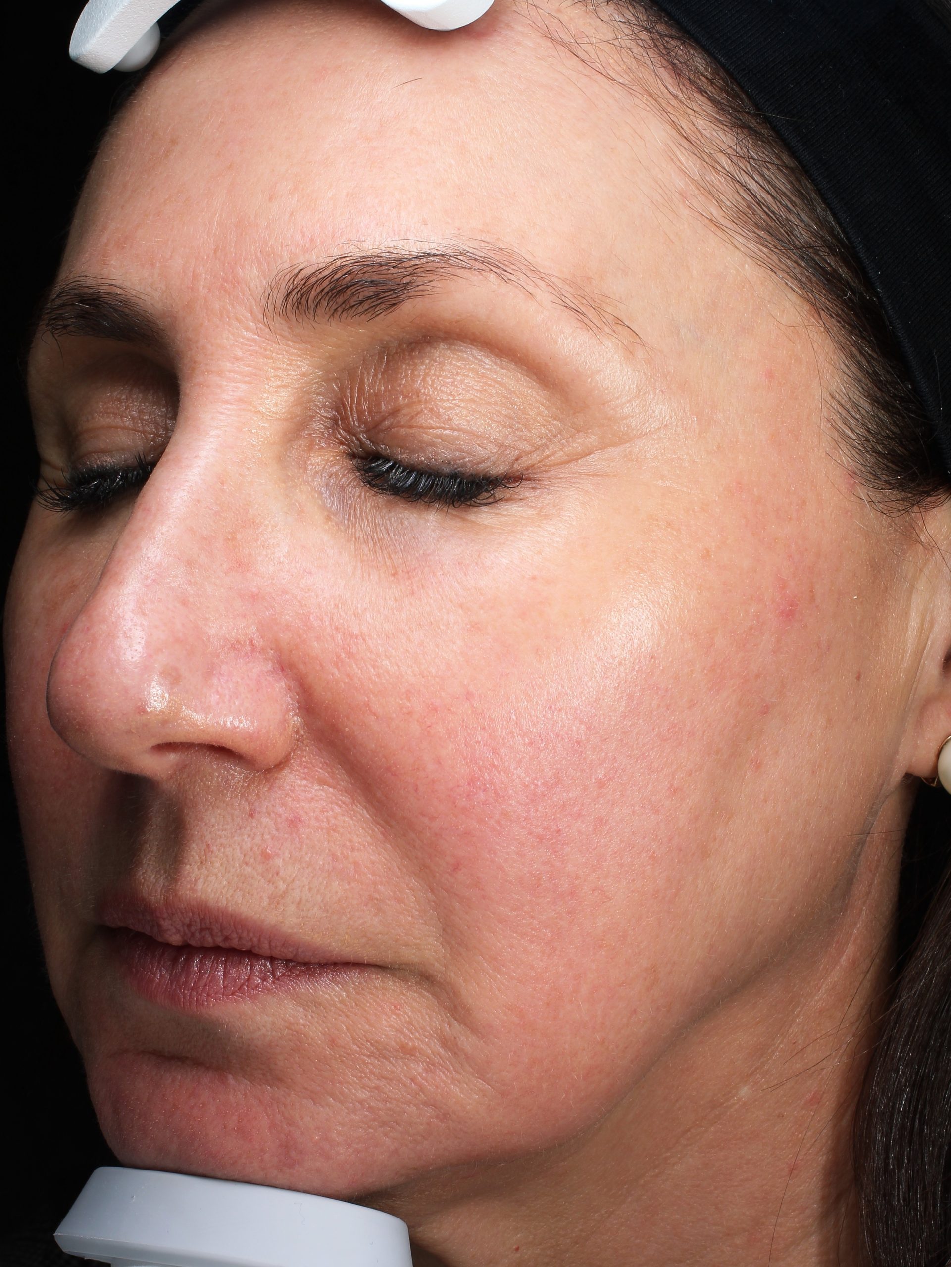 Patient 30 After Image