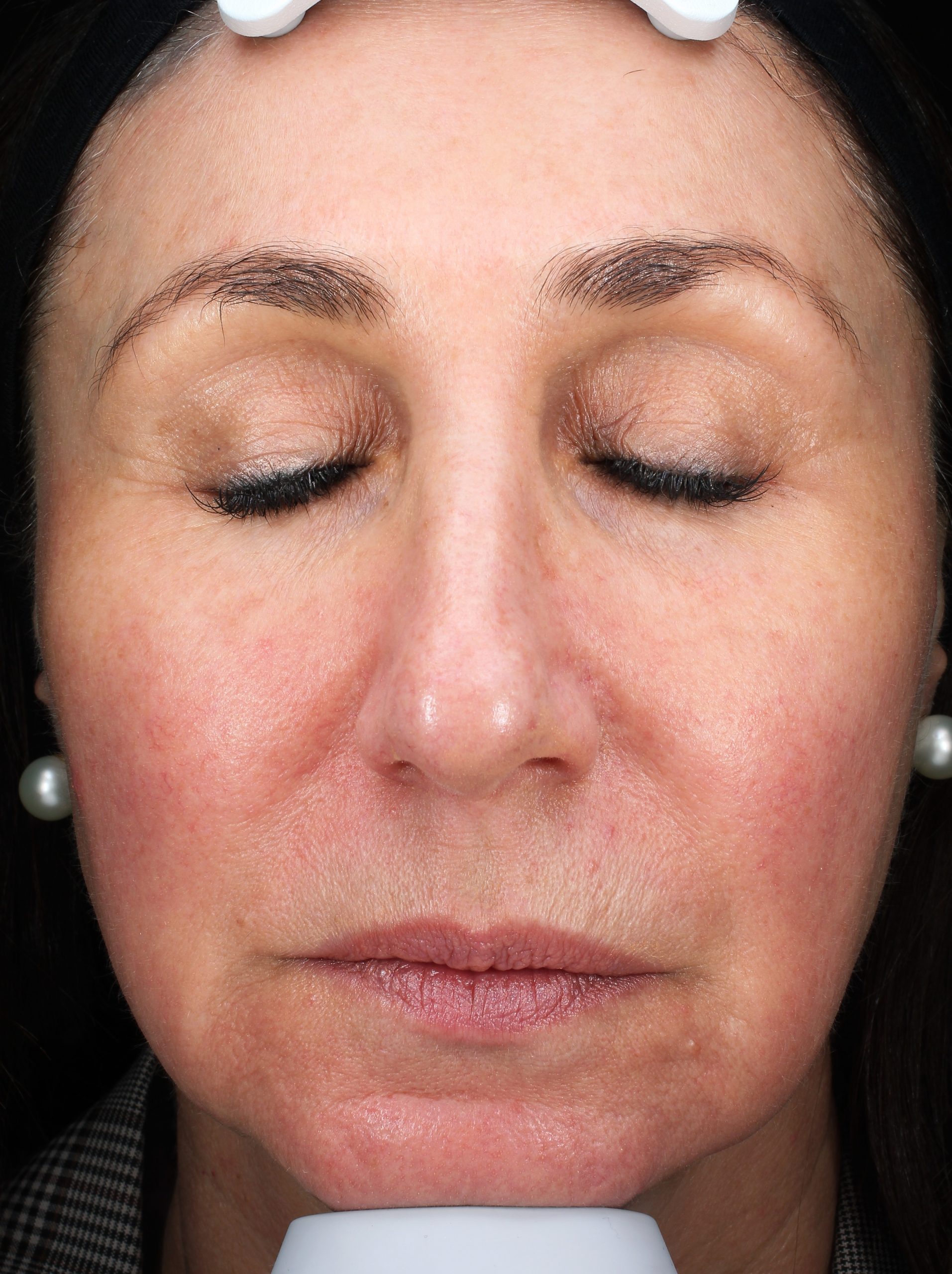 Patient 30 After Image