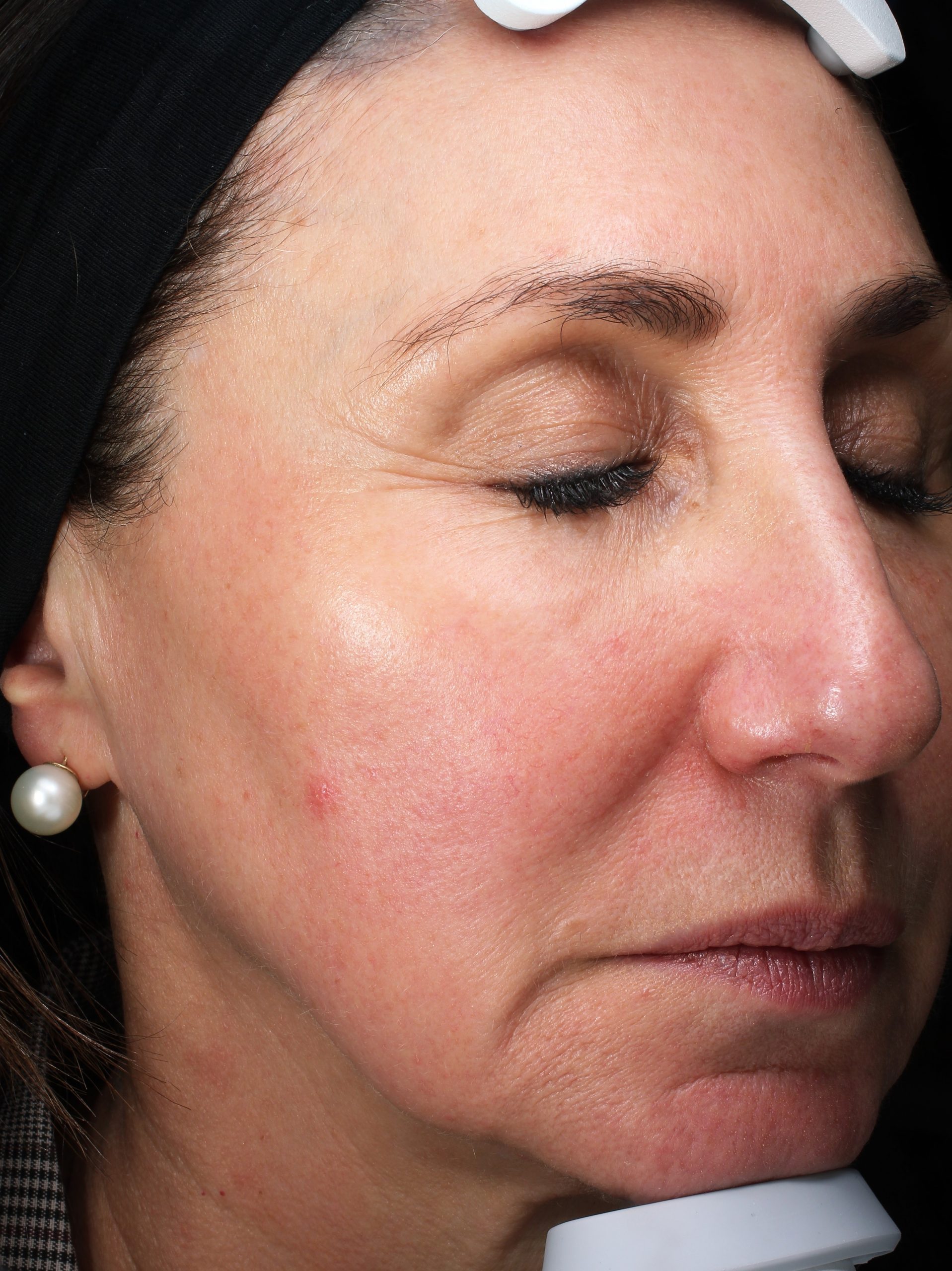 Patient 30 After Image