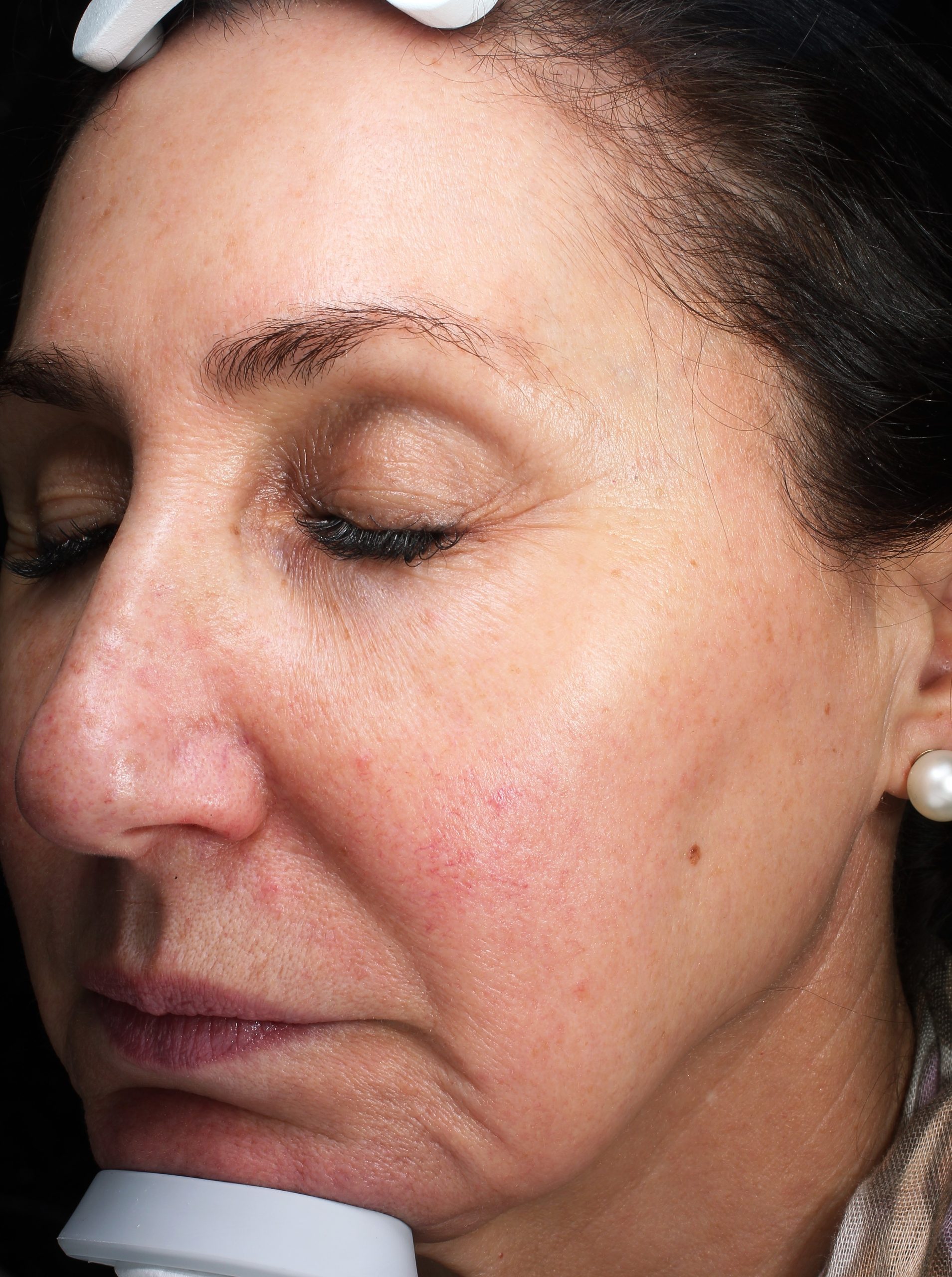 Patient 30 Before Image