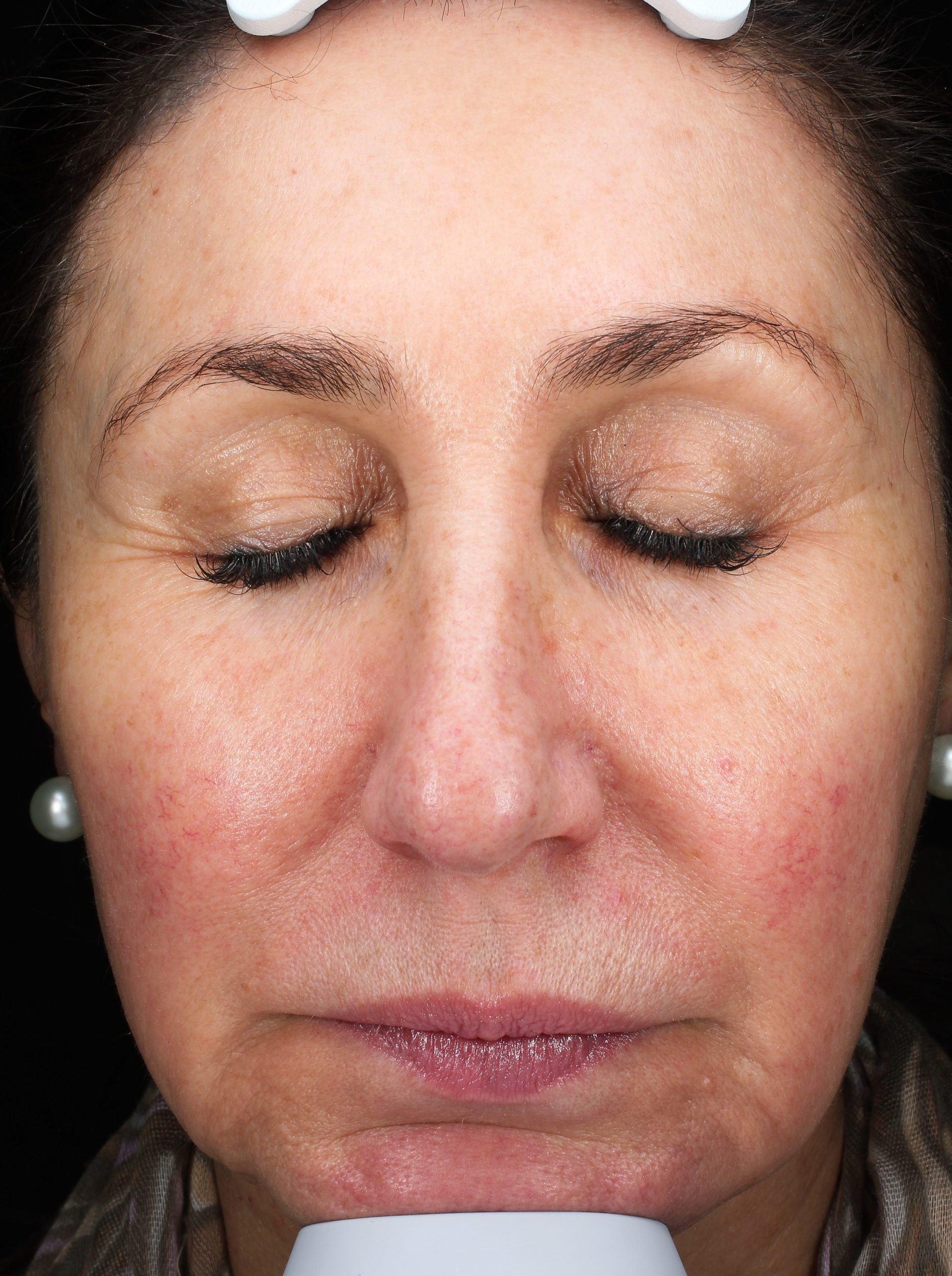 Patient 30 Before Image