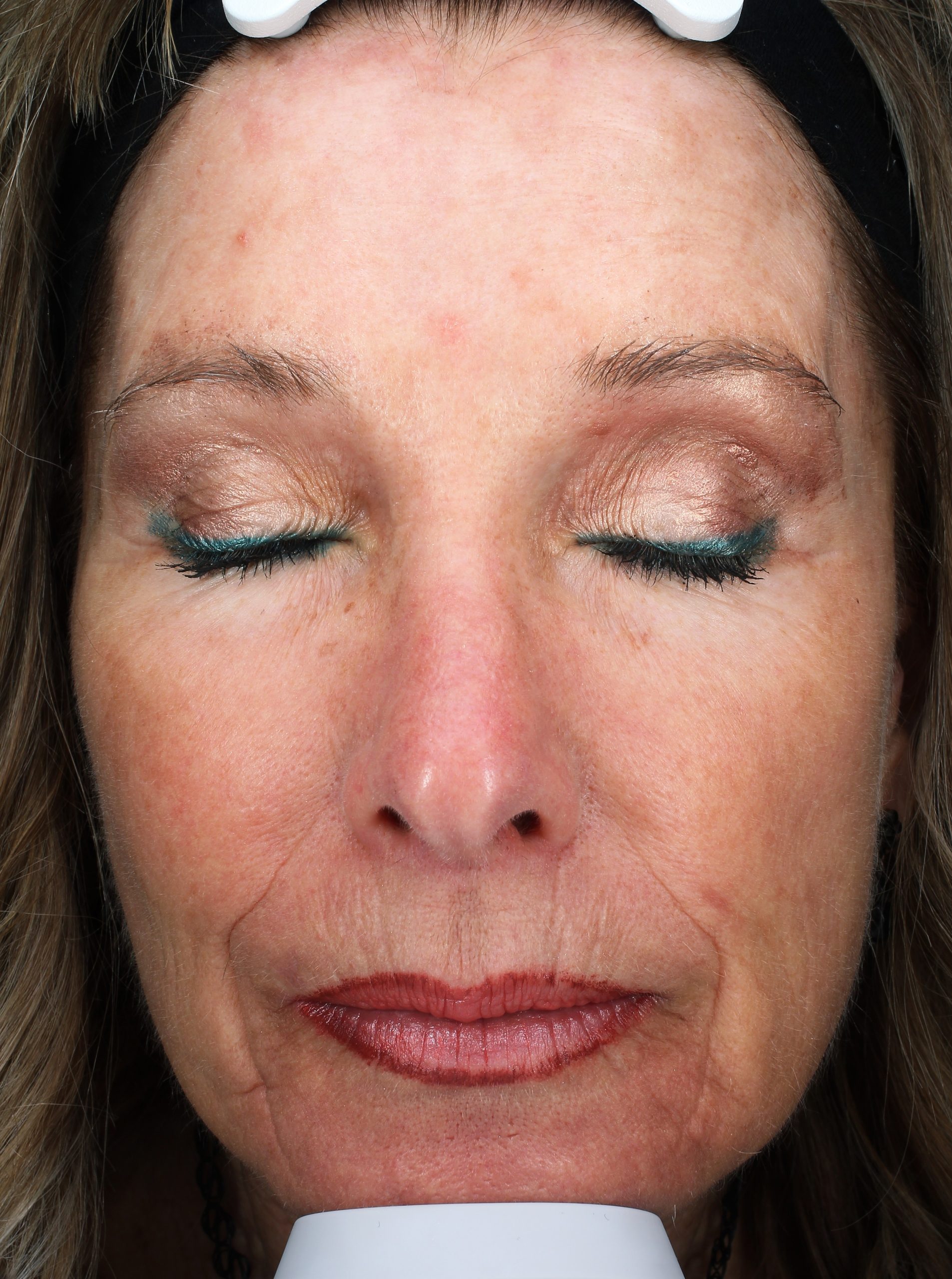 Patient 26 After Image