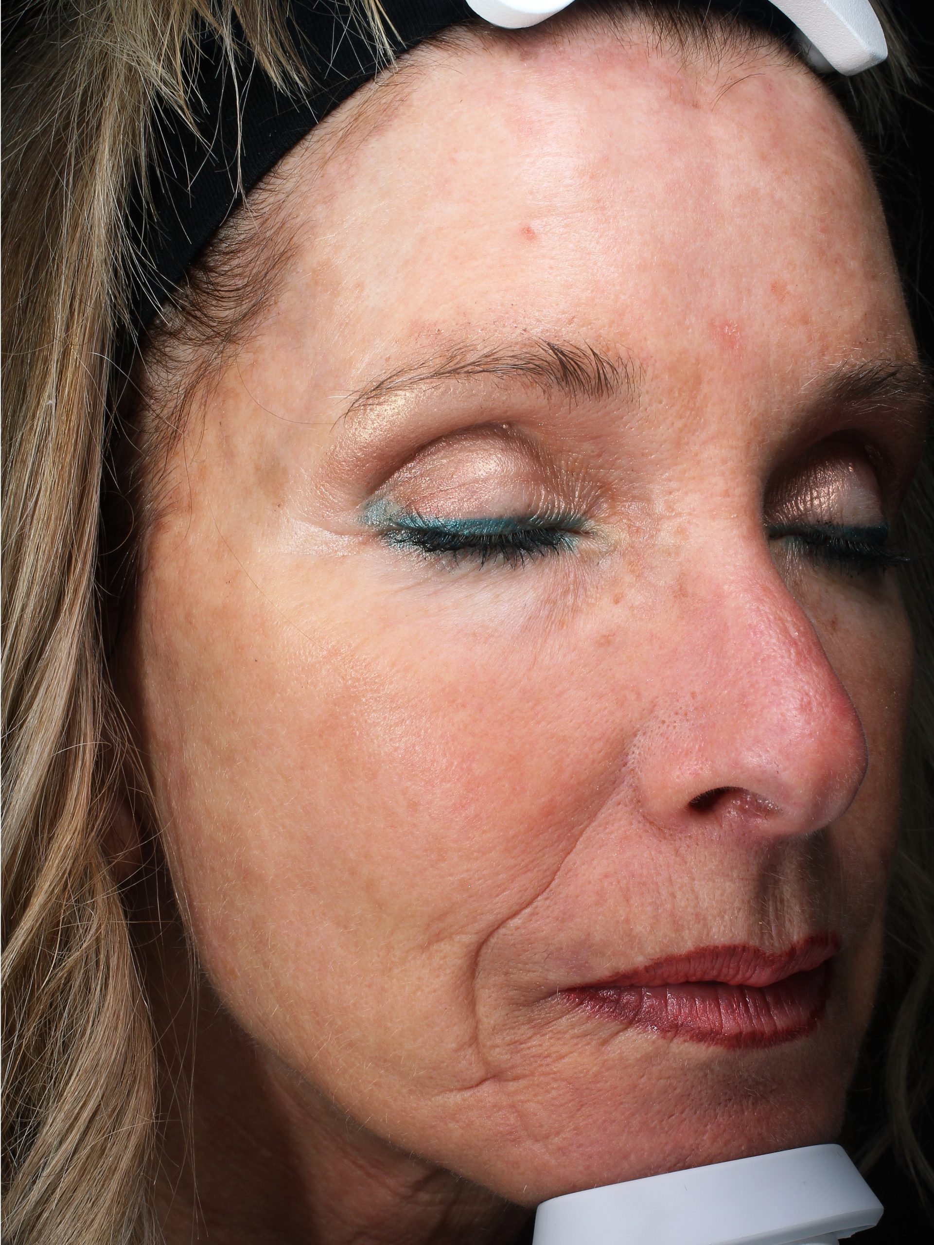 Patient 26 After Image