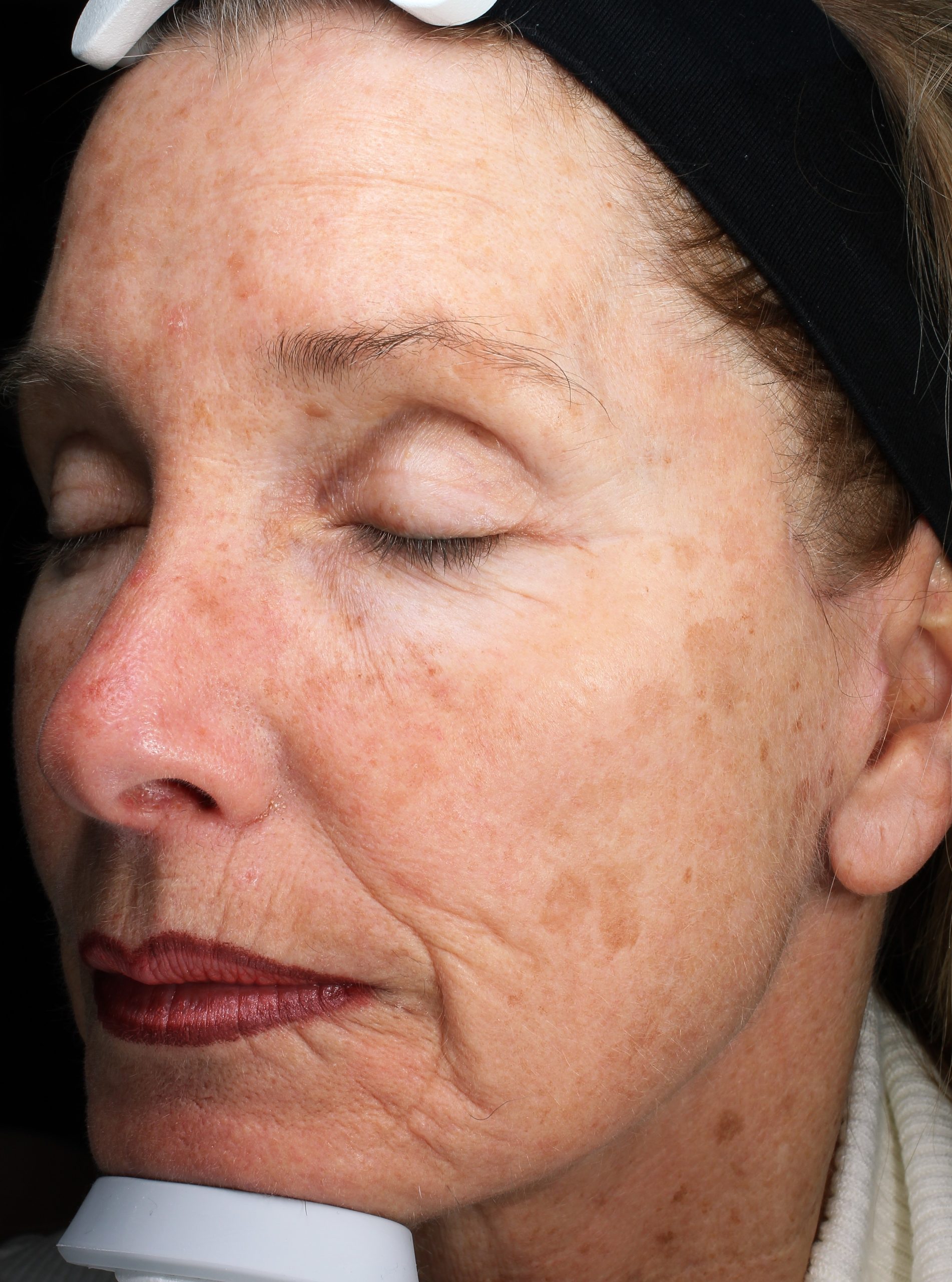 Patient 26 Before Image